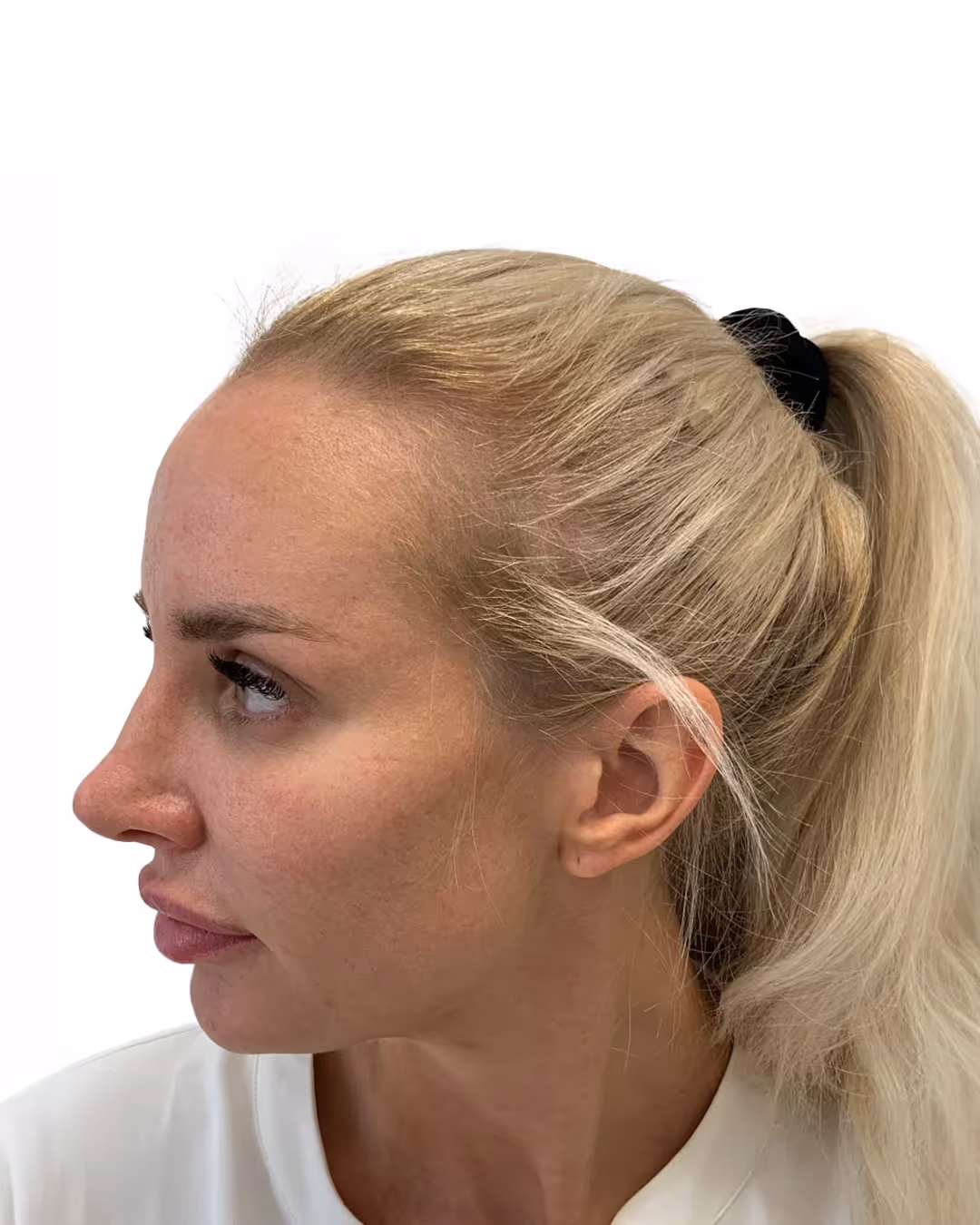 Julia före hårtransplantationen