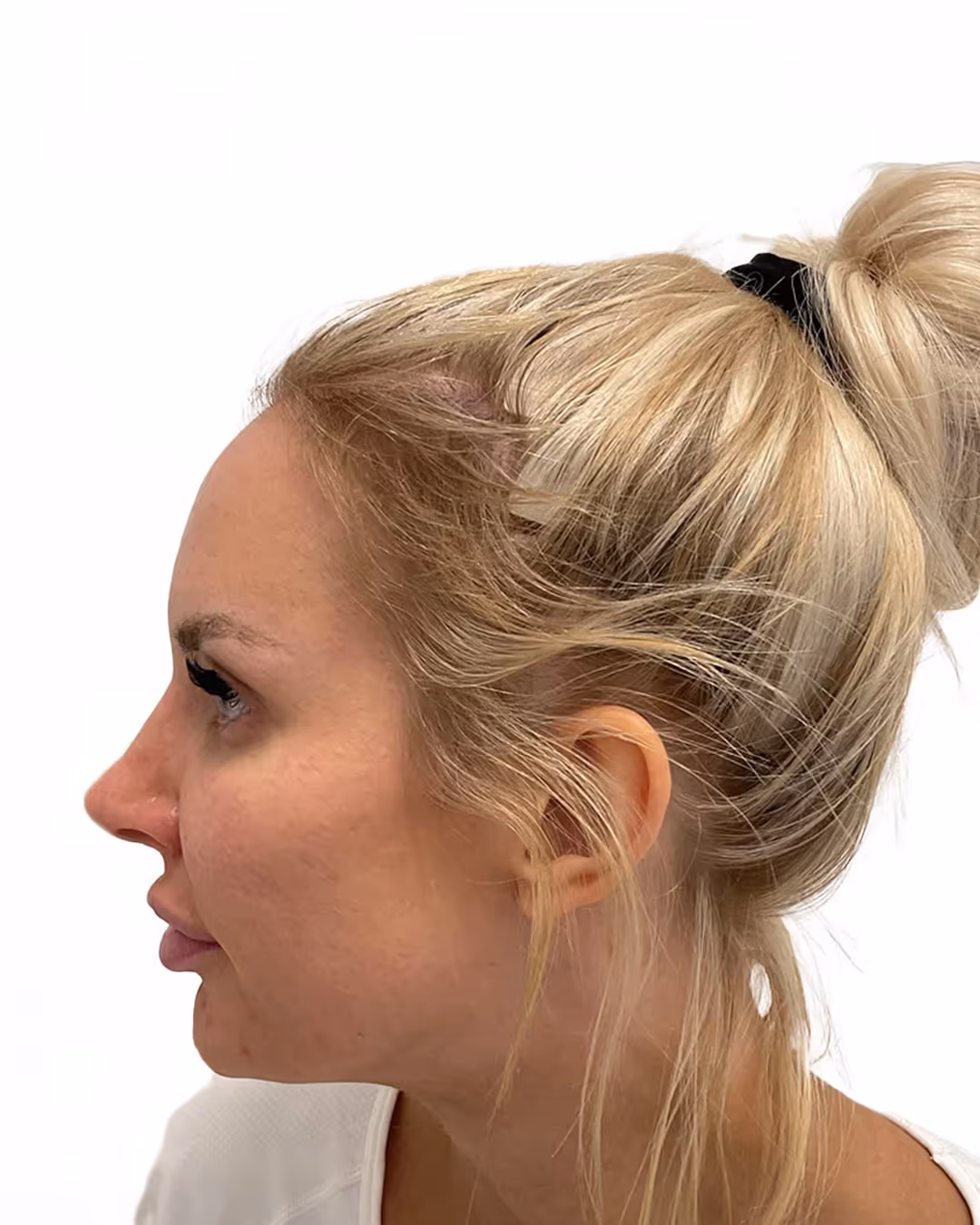 Julia efter hårtransplantationen