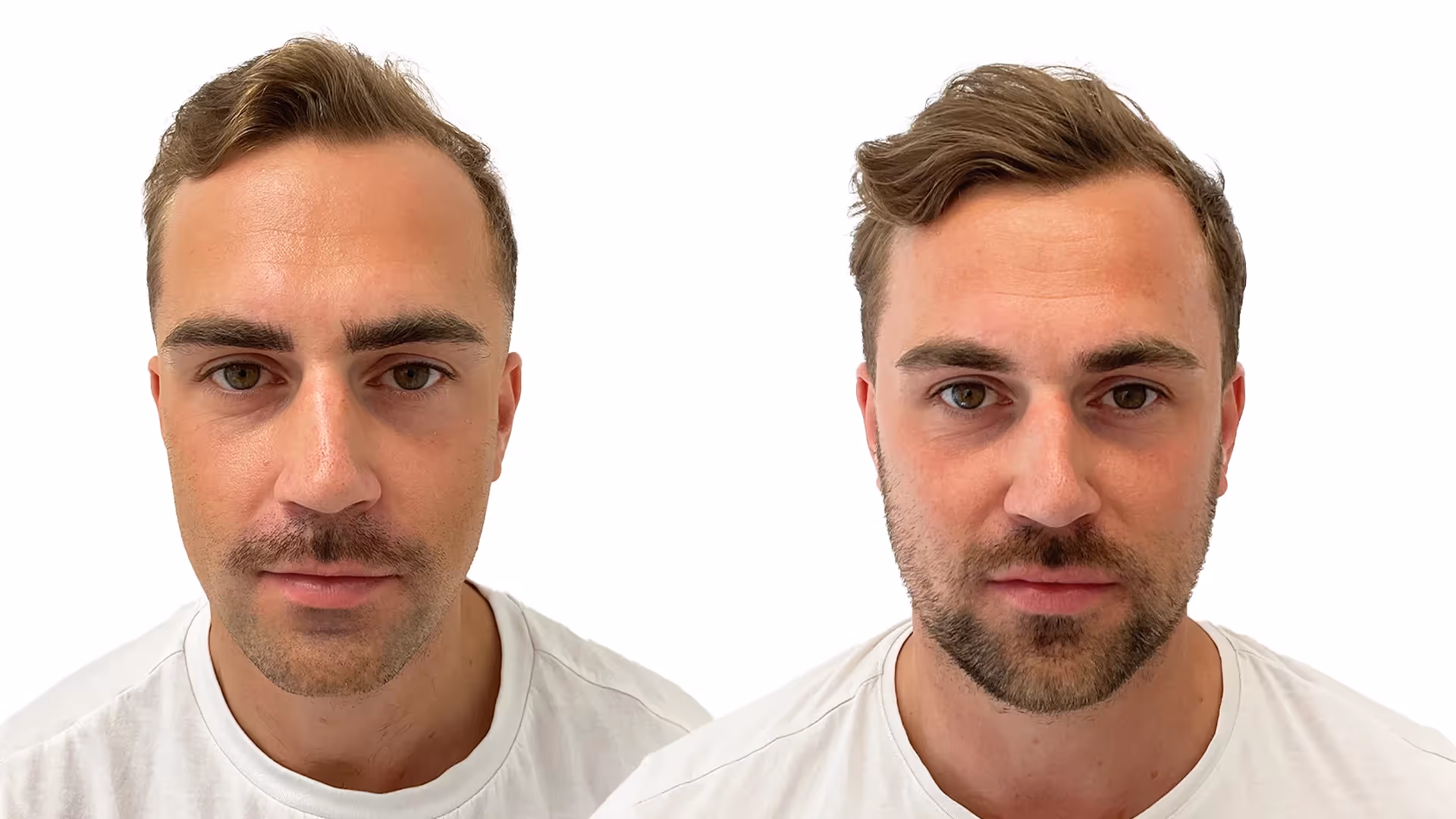 Joakim – före och efter sin hårbehandling