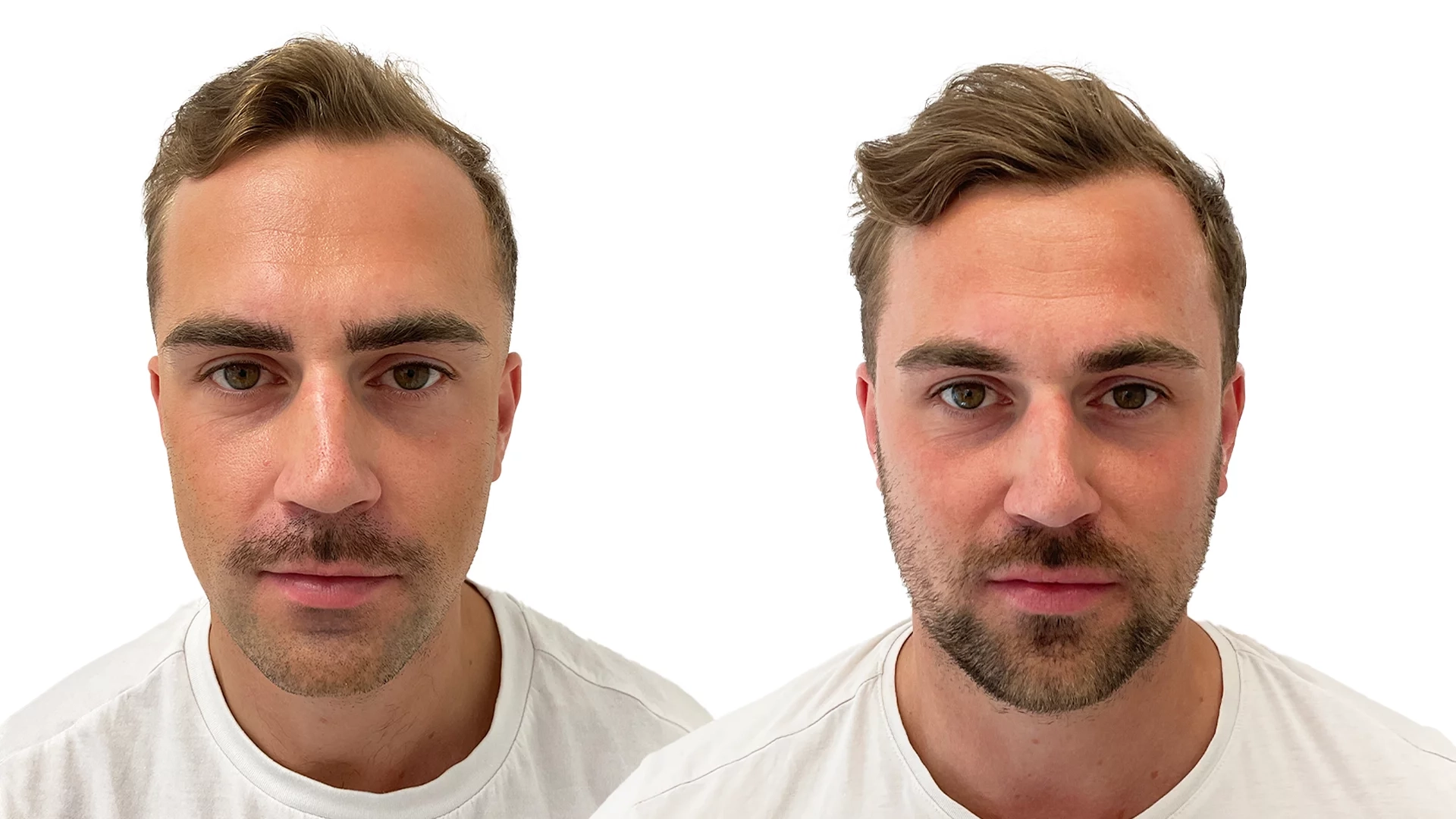 Joakim – före och efter sin hårbehandling