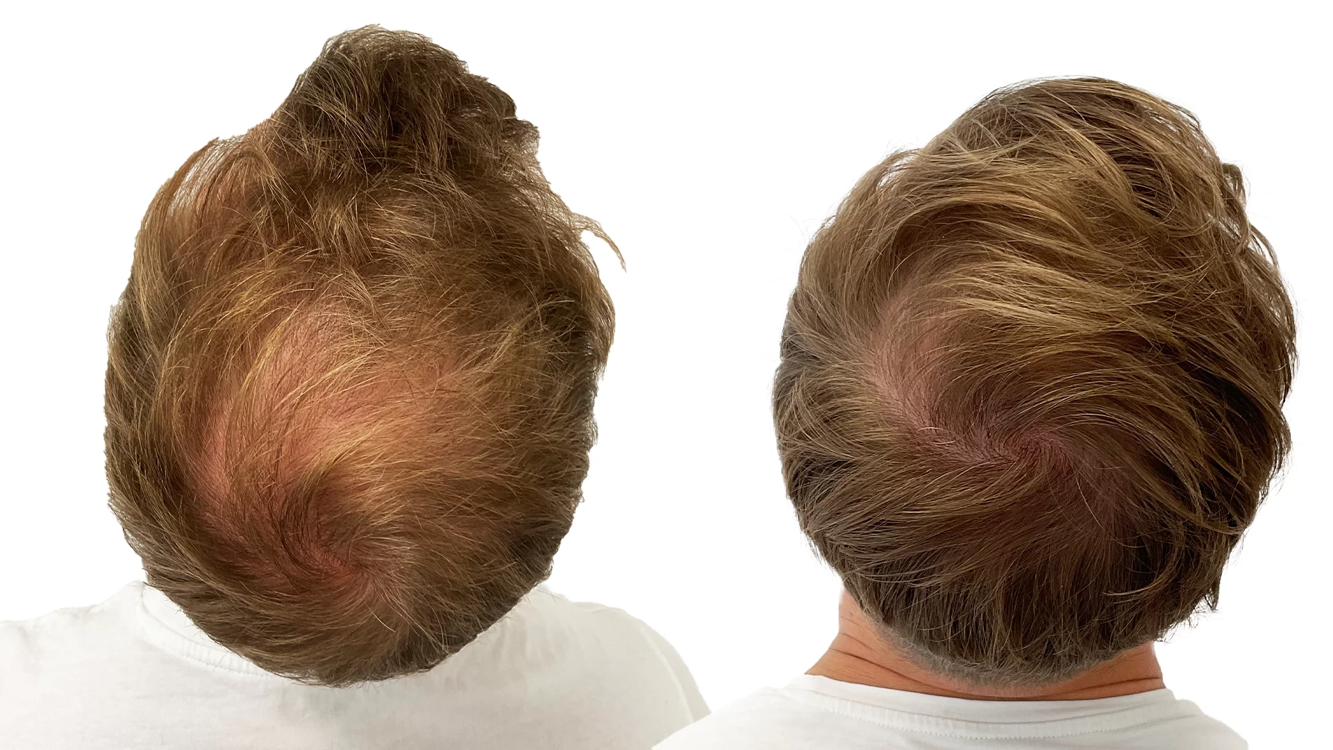 Joakim – före och efter sin hårbehandling