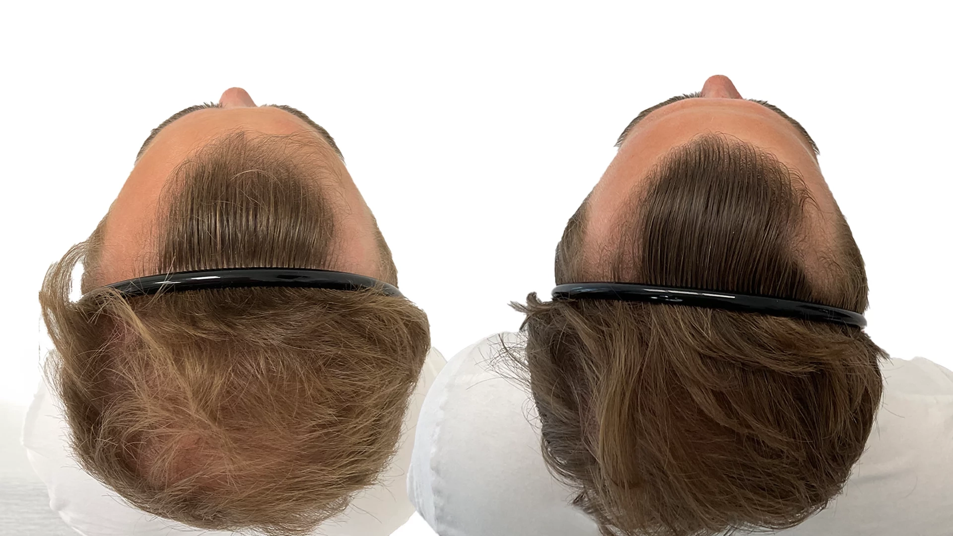 Joakim – före och efter sin hårbehandling