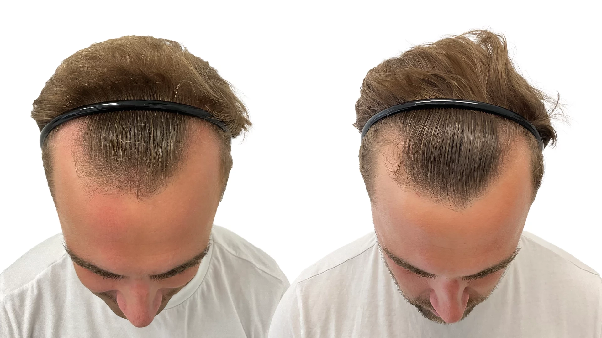 Joakim – före och efter sin hårbehandling