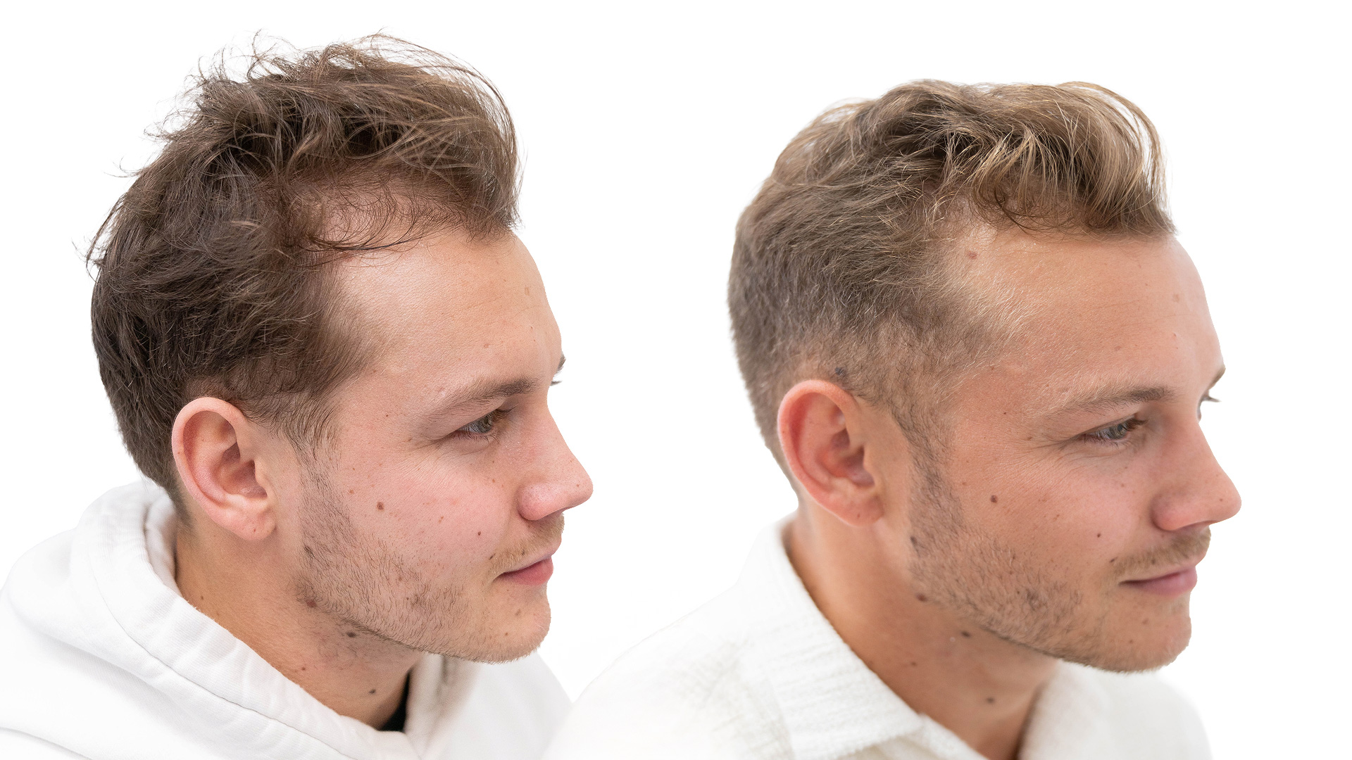 Jesper – före och efter sin hårbehandling