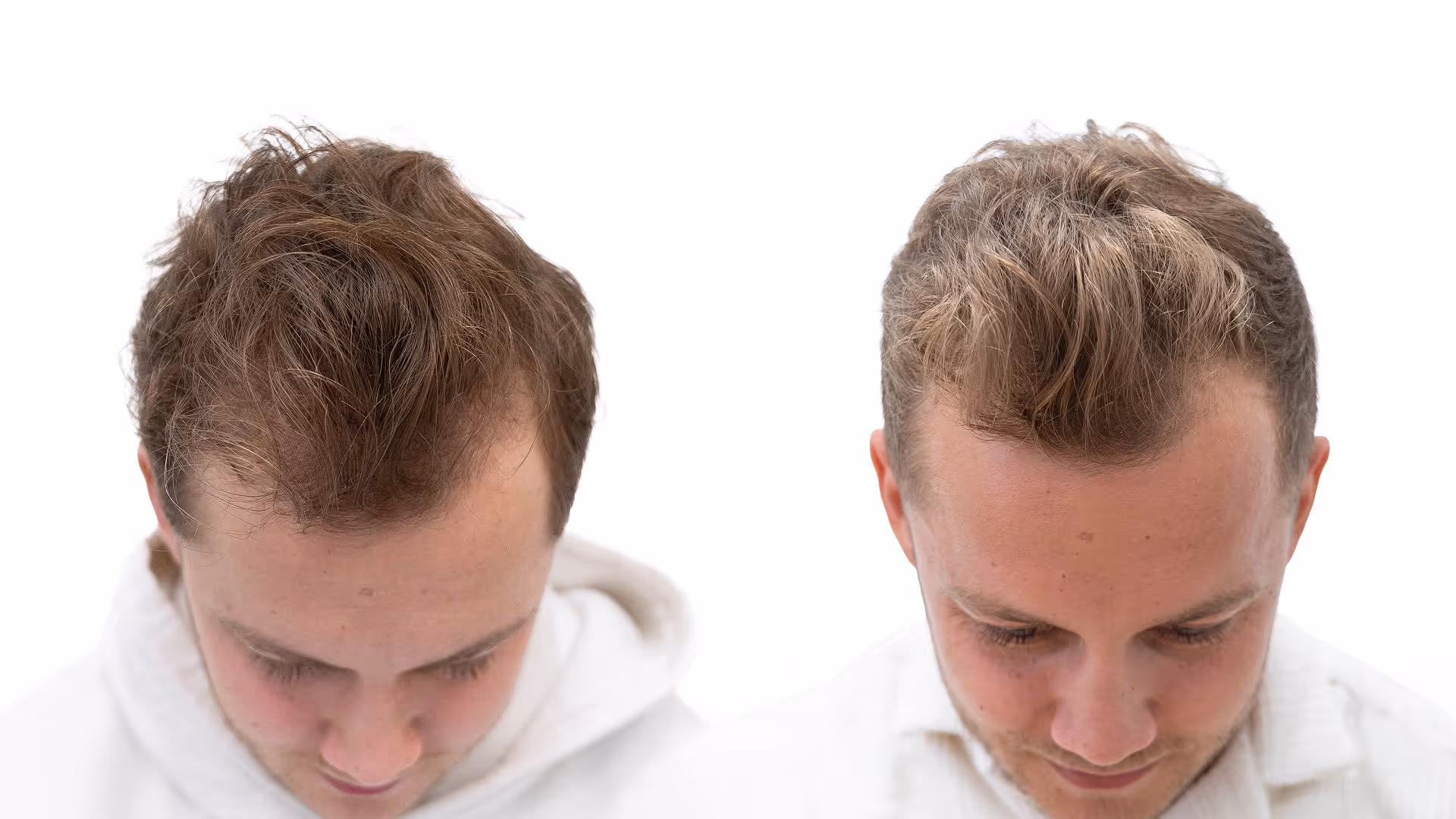 Jesper – före och efter sin hårbehandling