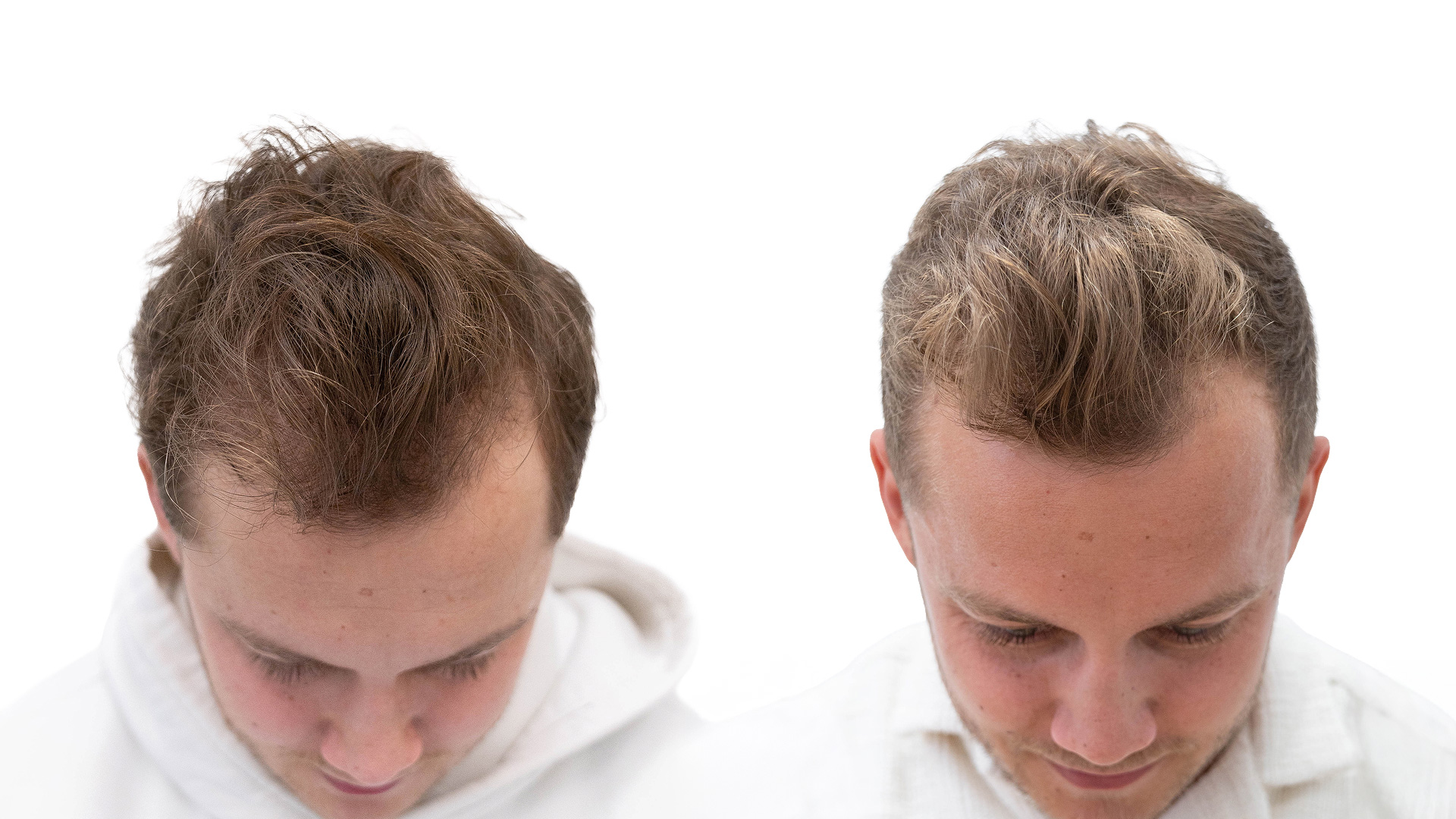 Jesper – före och efter sin hårbehandling