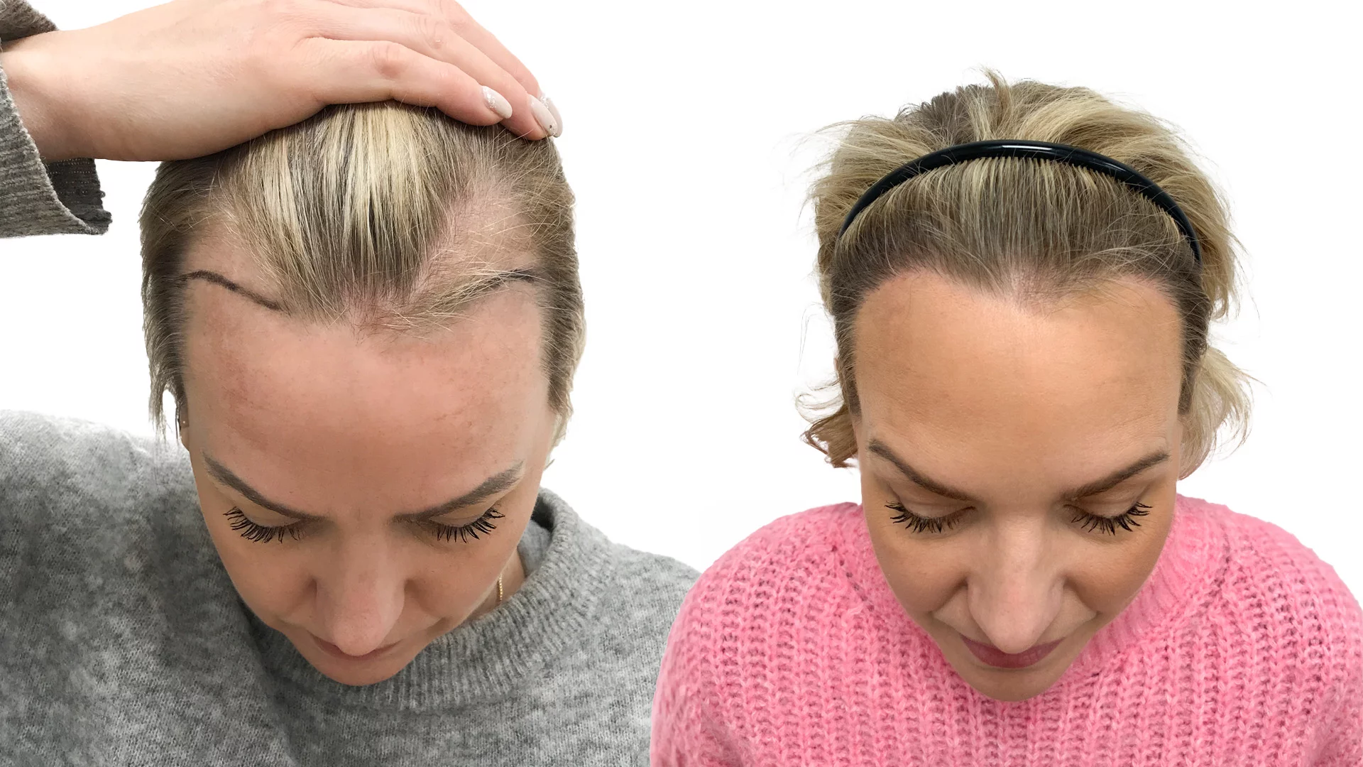 Jennie – före och efter sin hårtransplantation