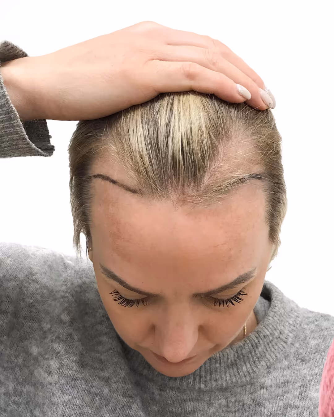 Jennie före hårtransplantationen