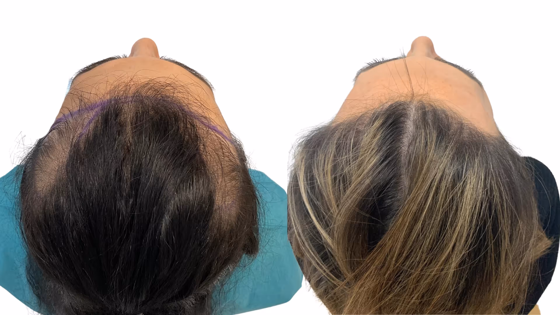 Ines – före och efter sin hårtransplantation