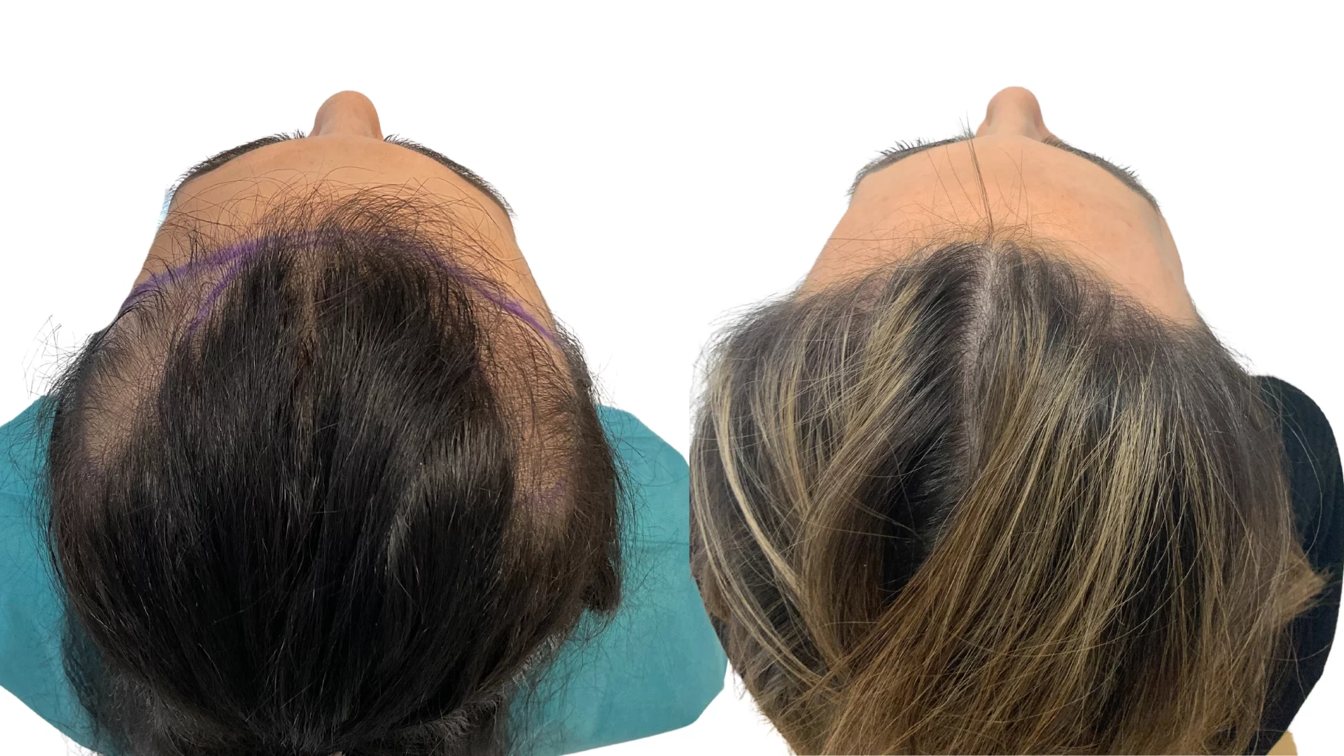 Ines – före och efter sin hårtransplantation