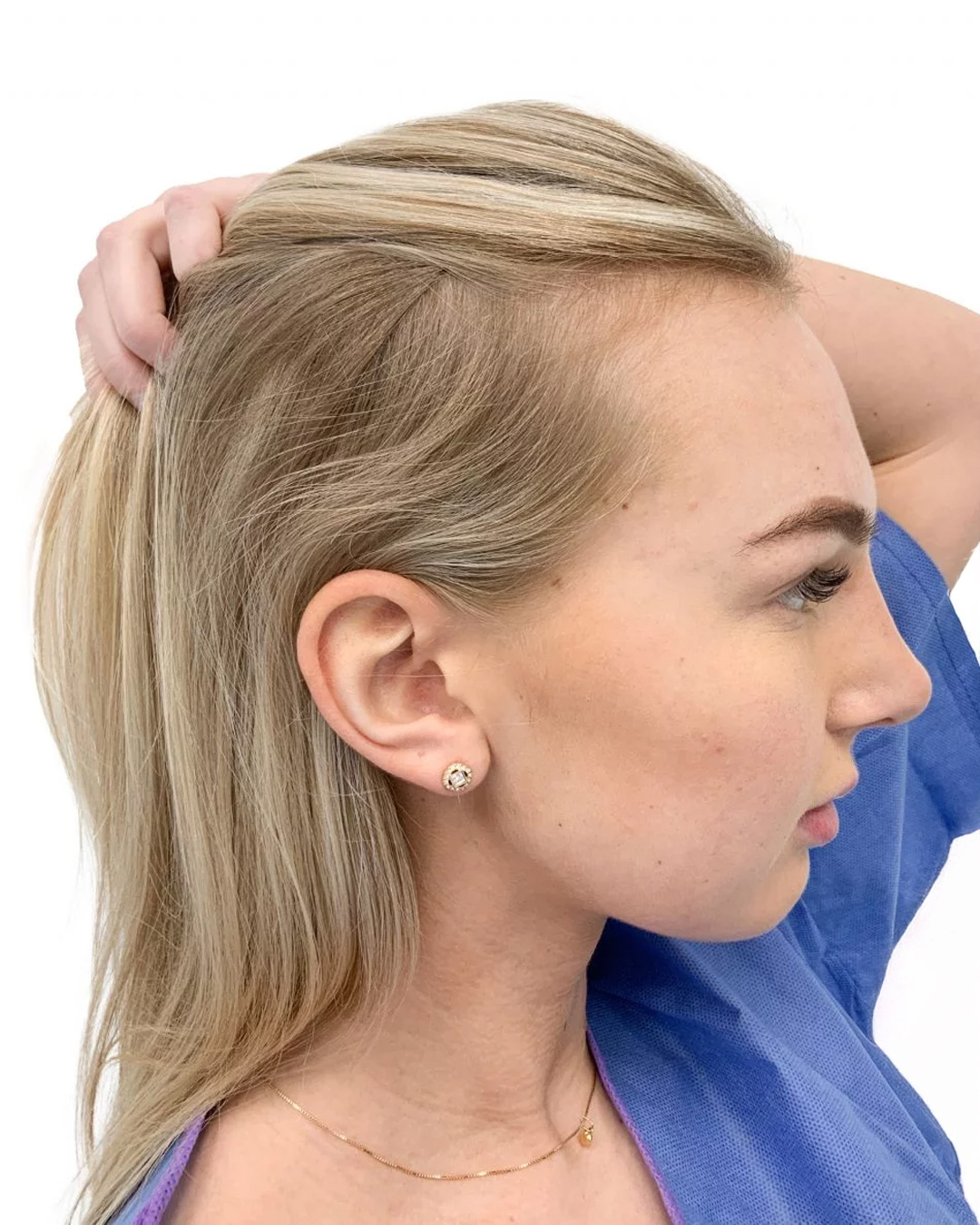 Ida före hårtransplantationen