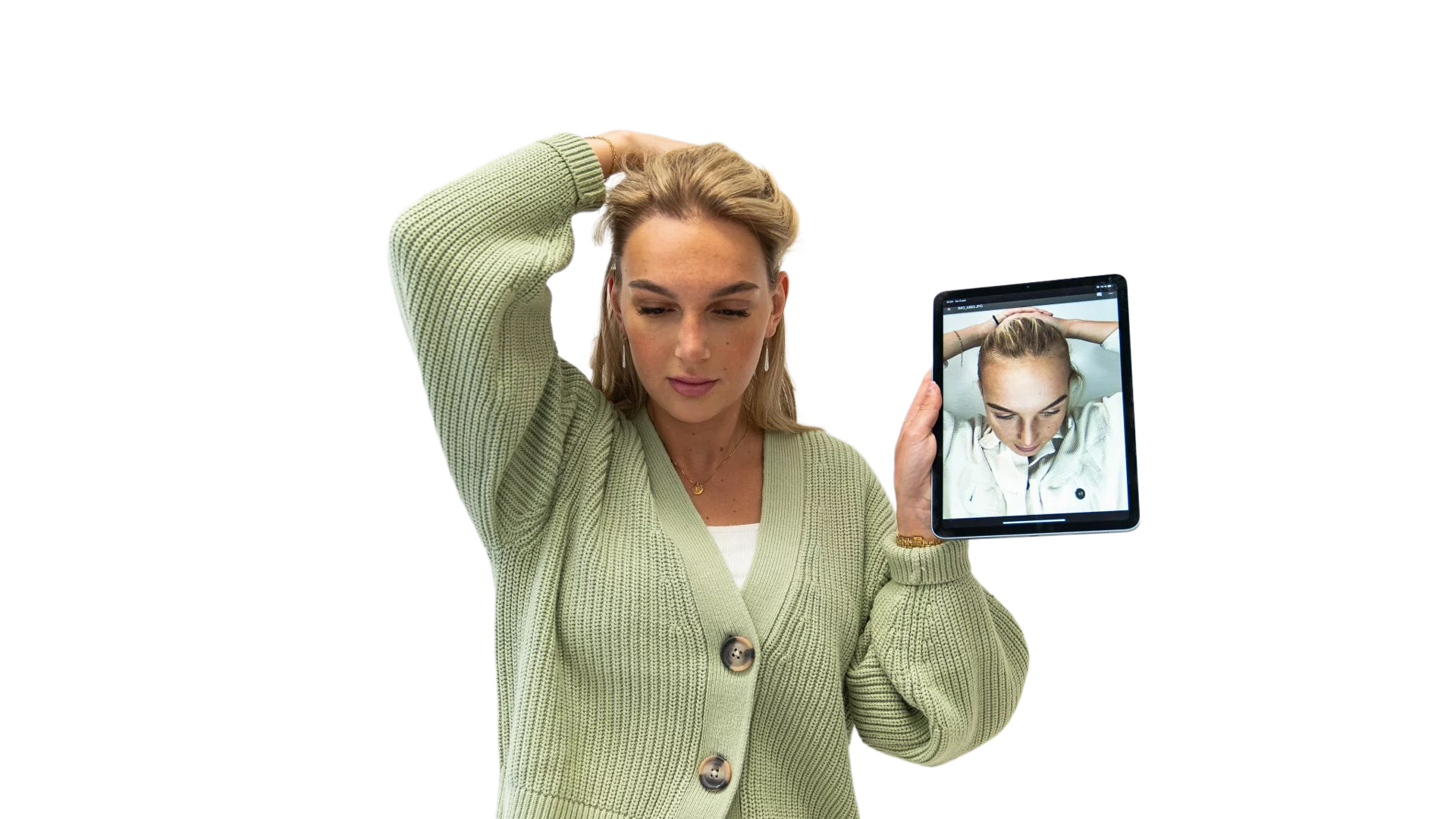 Ida – före och efter sin hårtransplantation