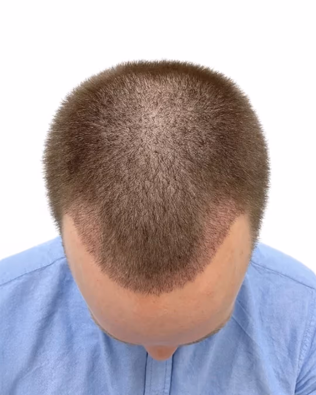 Henrik efter hårtransplantationen