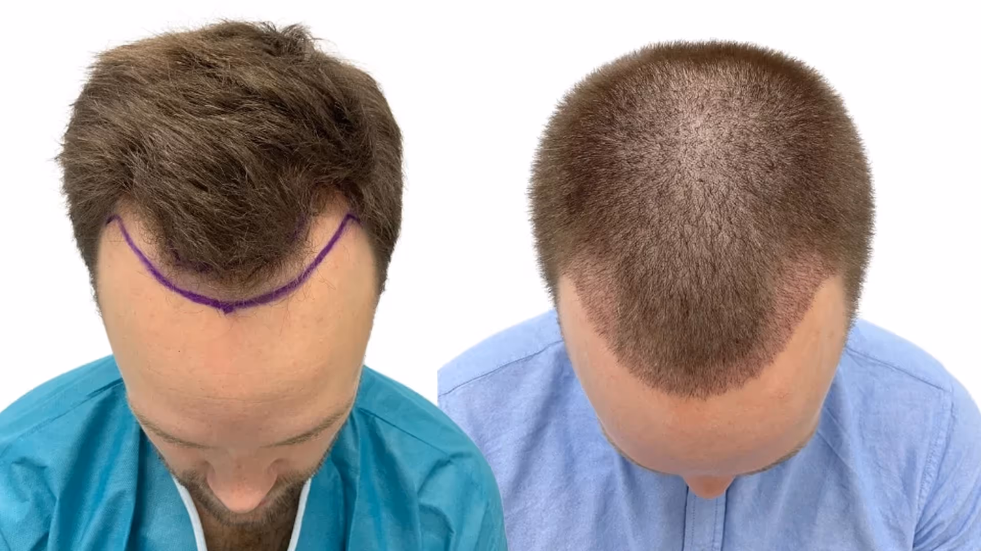 Henrik – före och efter sin hårtransplantation