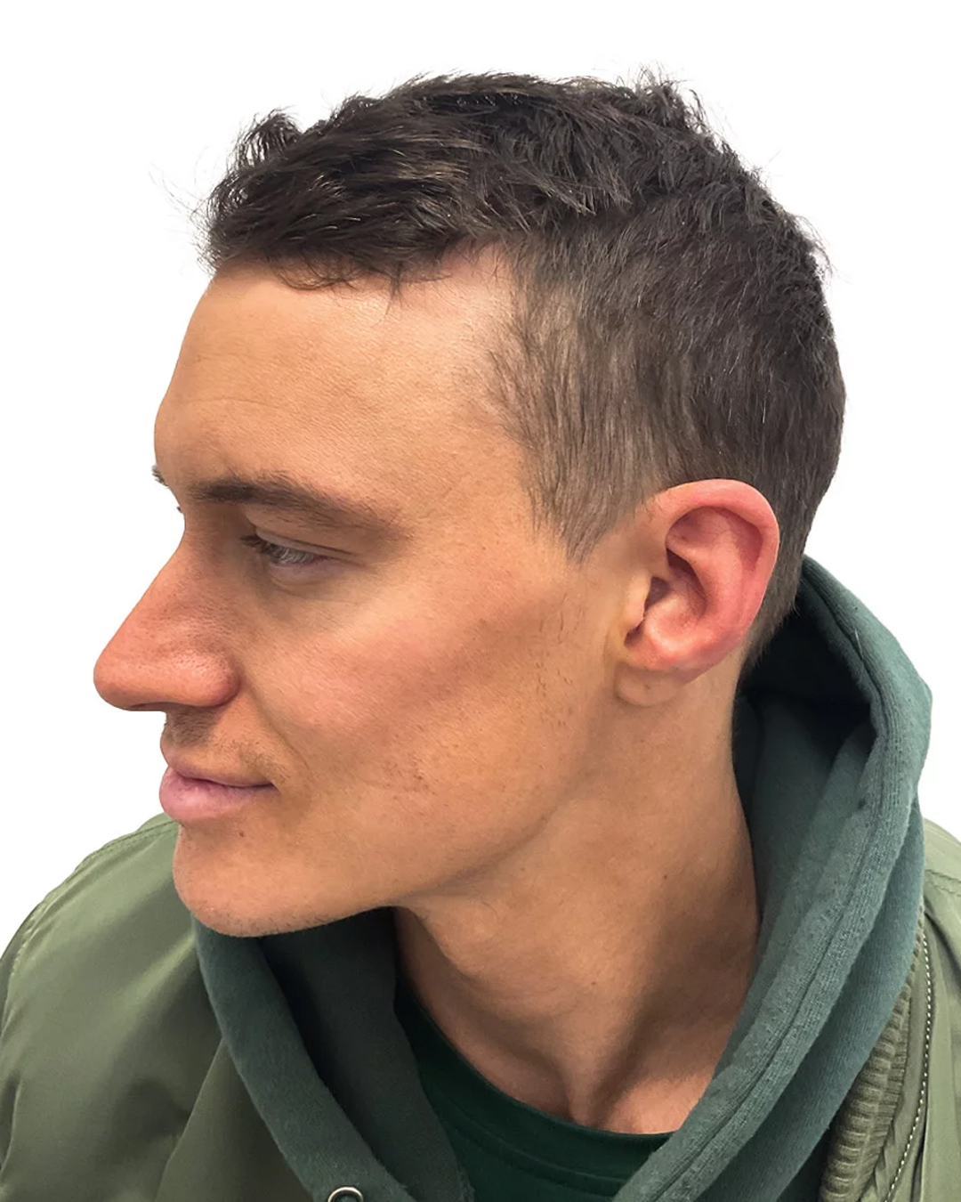 Henrik efter hårtransplantationen