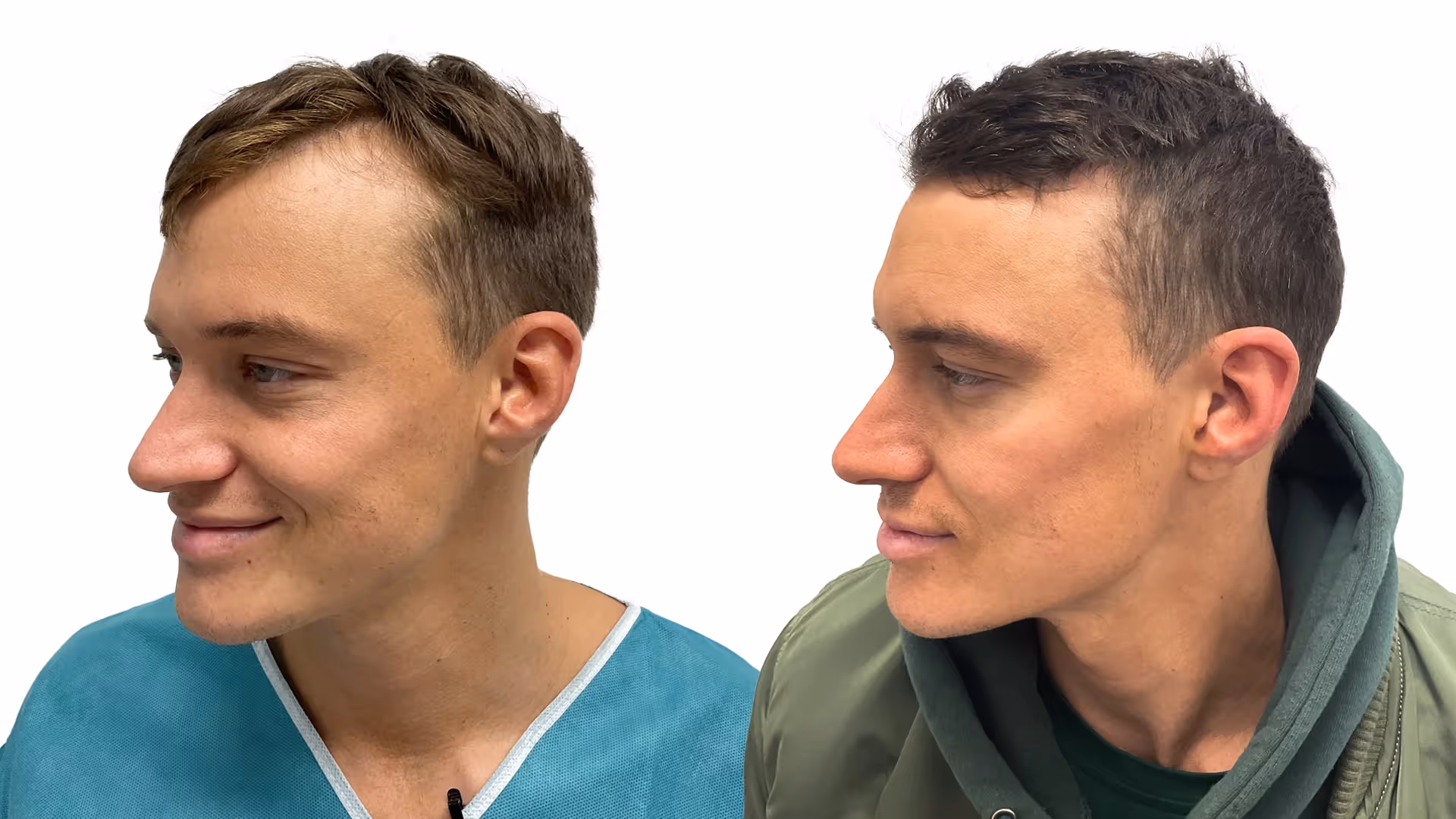 Henrik – före och efter sin hårtransplantation