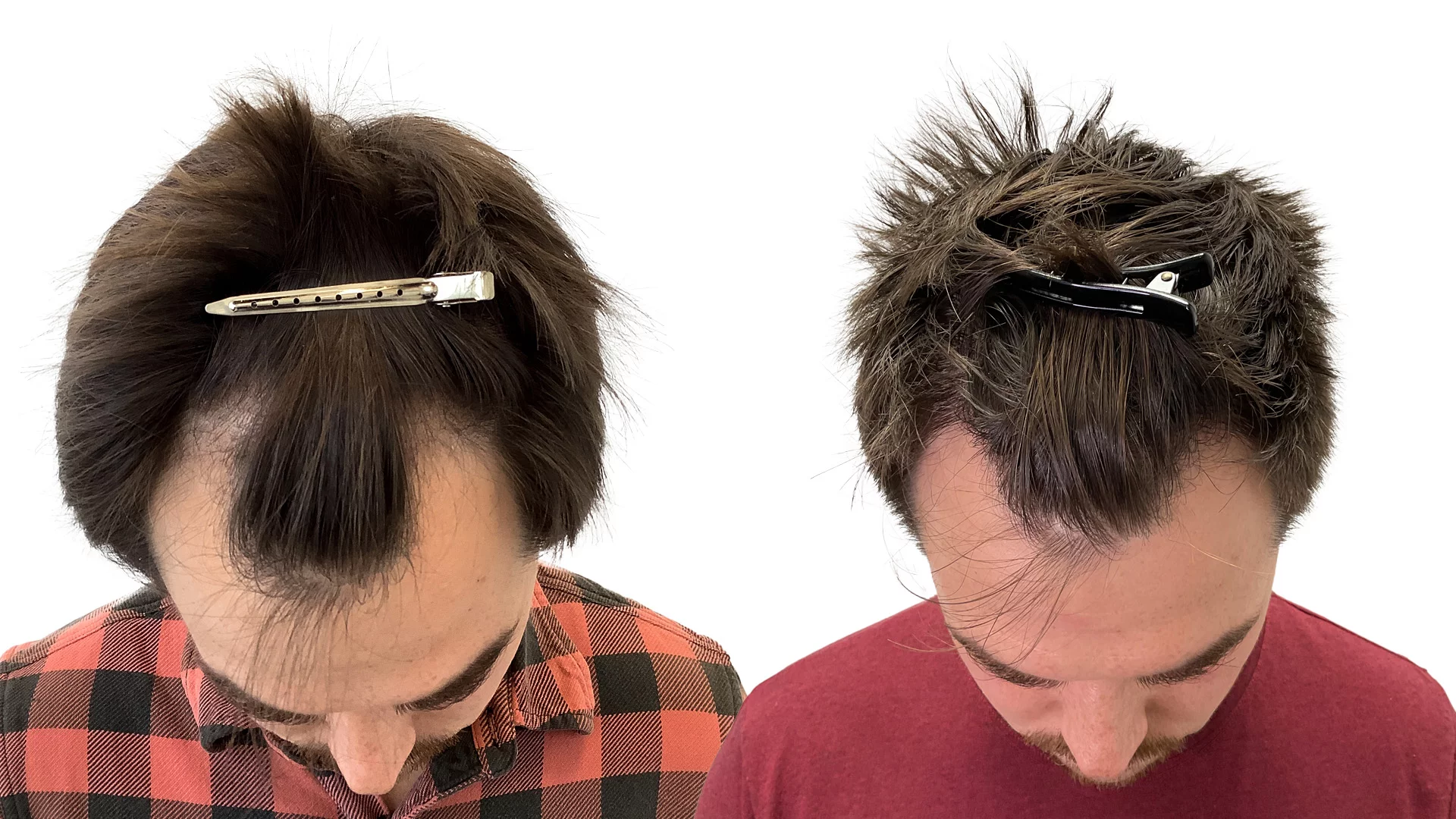 Hans – före och efter sin hårtransplantation