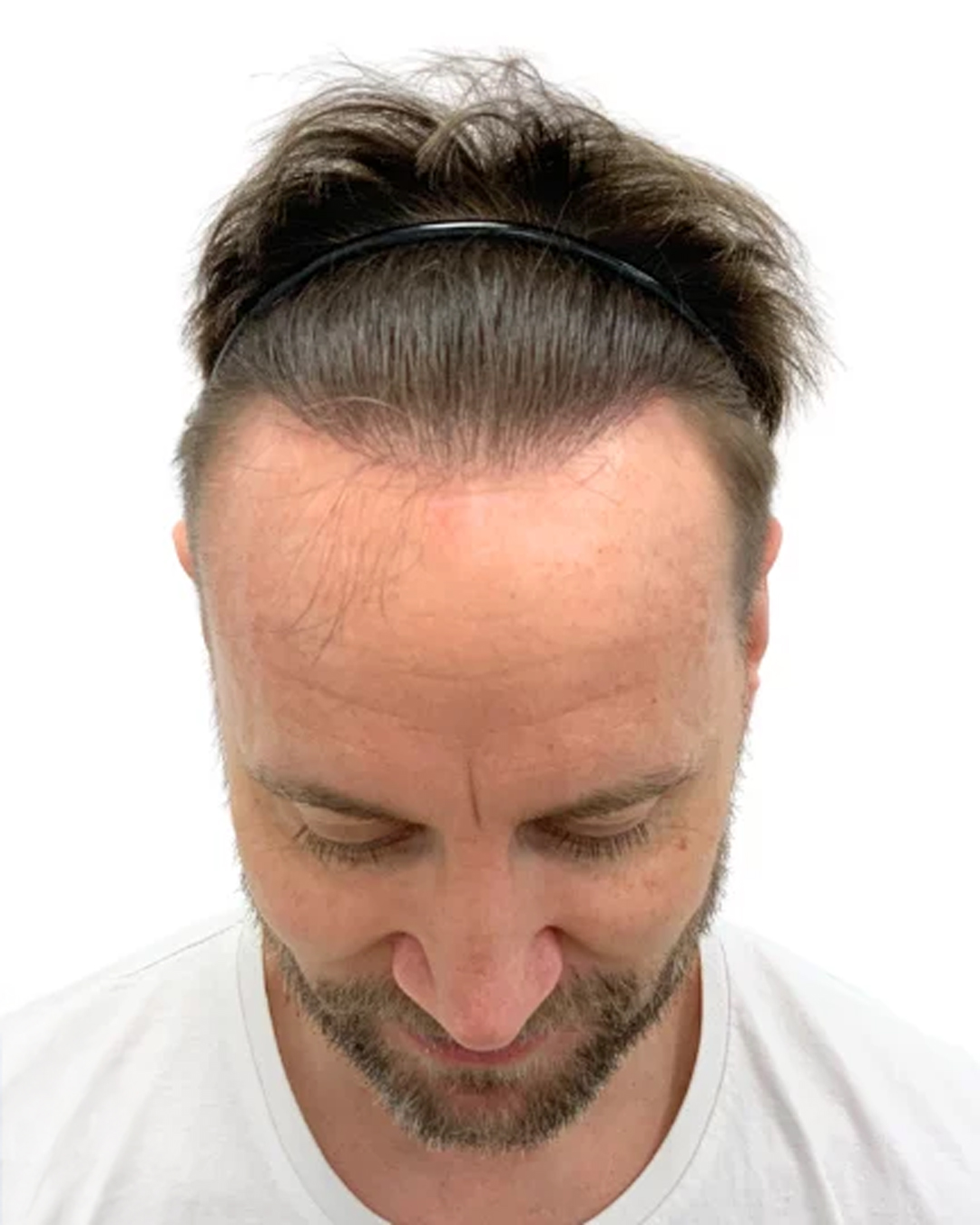 Franz efter hårtransplantationen