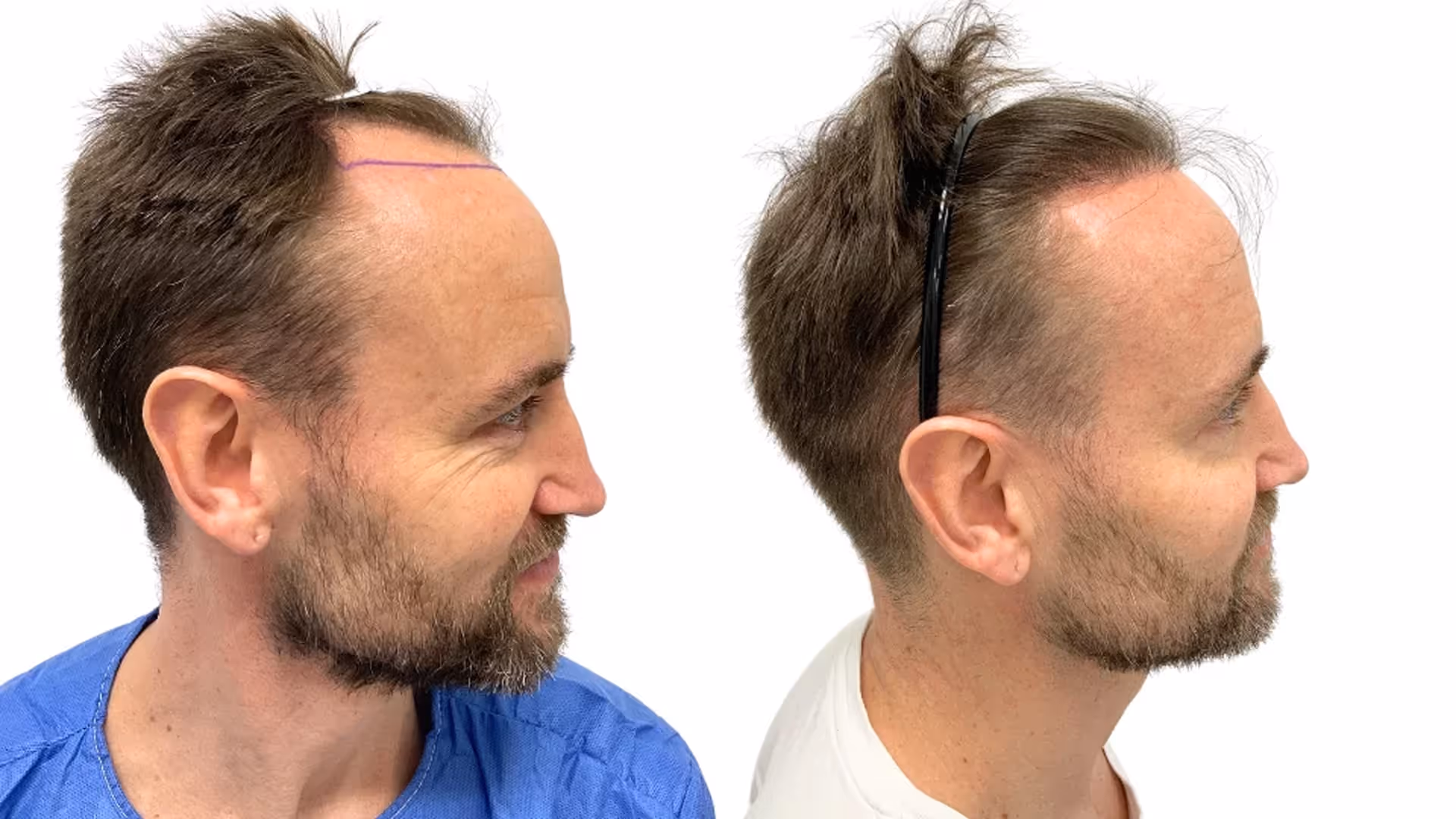 Franz – före och efter sin hårtransplantation
