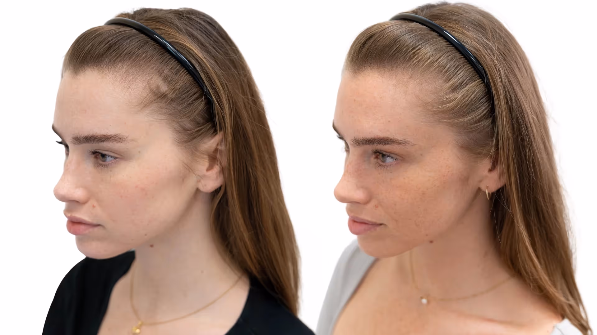 Emilia – före och efter sin hårbehandling