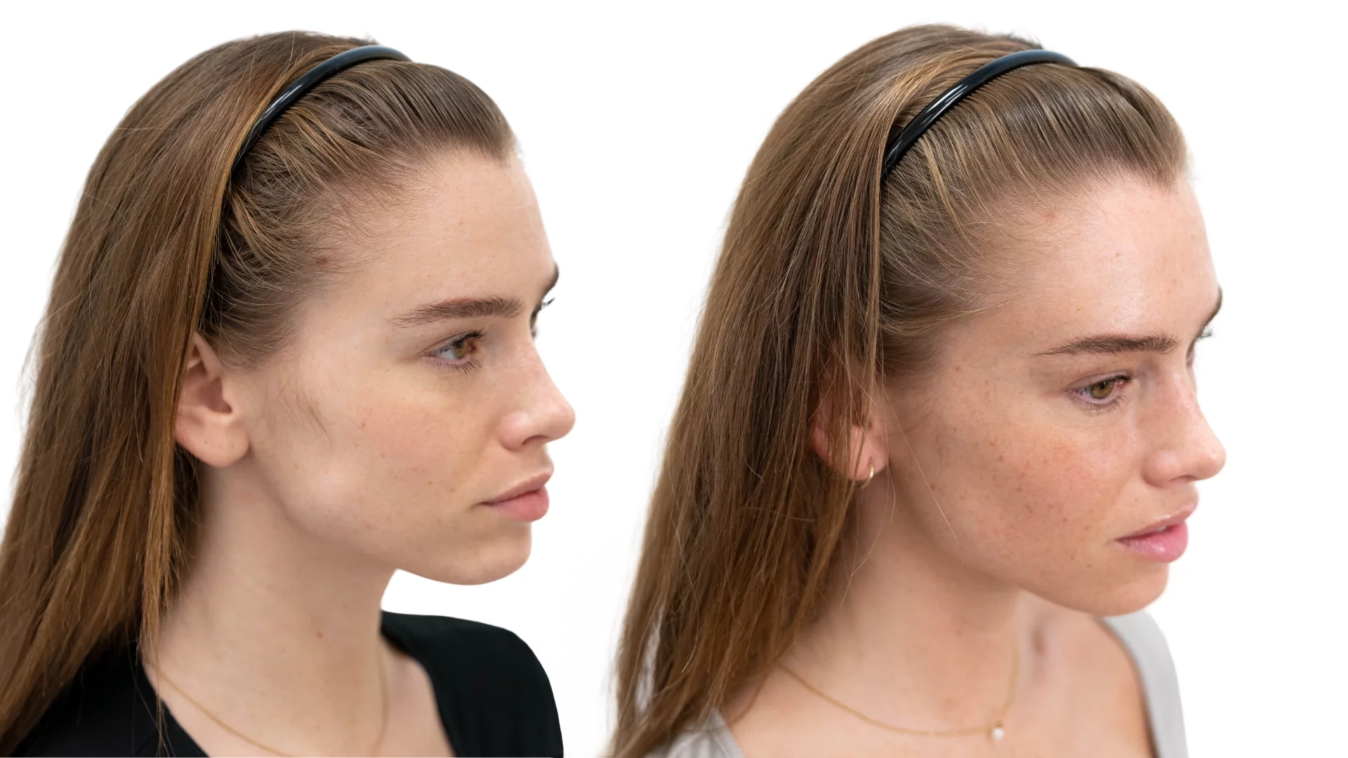 Emilia – före och efter sin hårbehandling