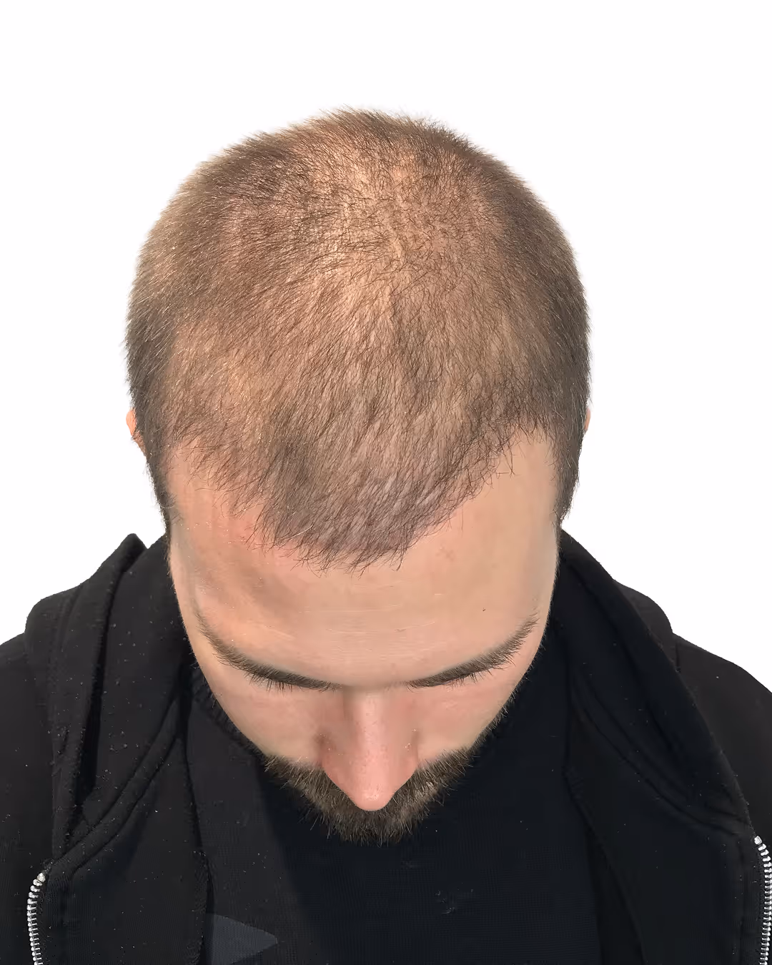 Elias efter hårtransplantationen