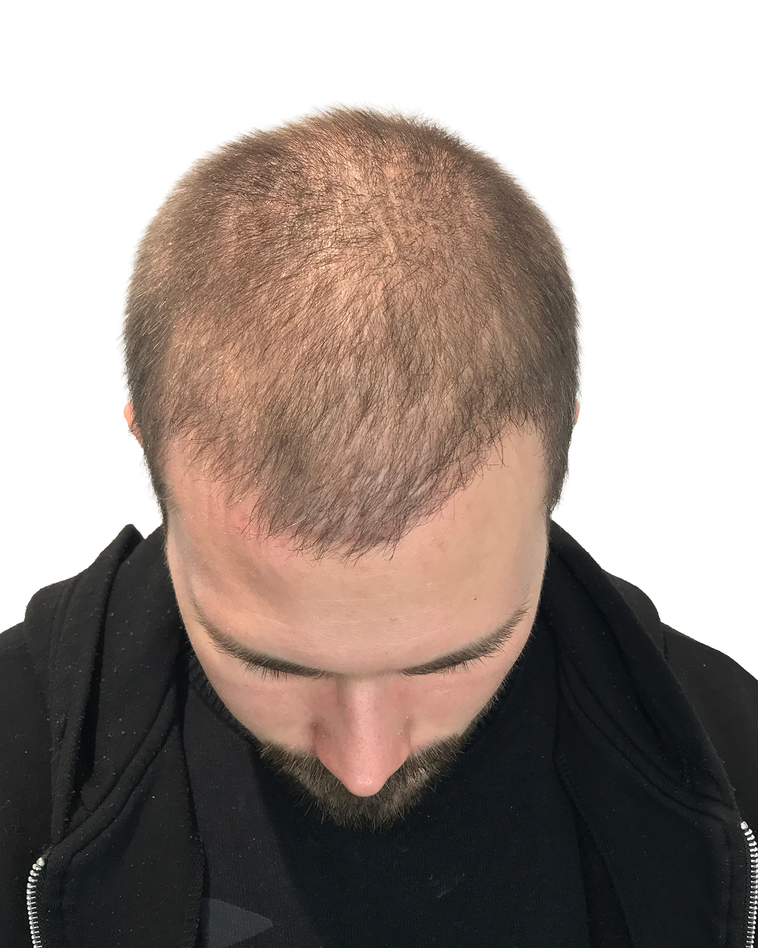 Elias efter hårtransplantationen