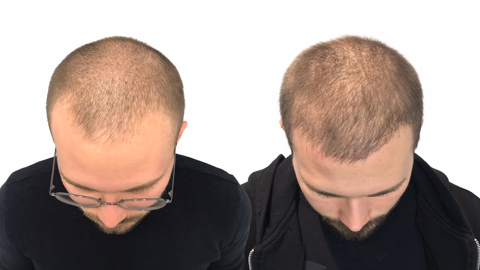 Elias – före och efter sin hårtransplantation