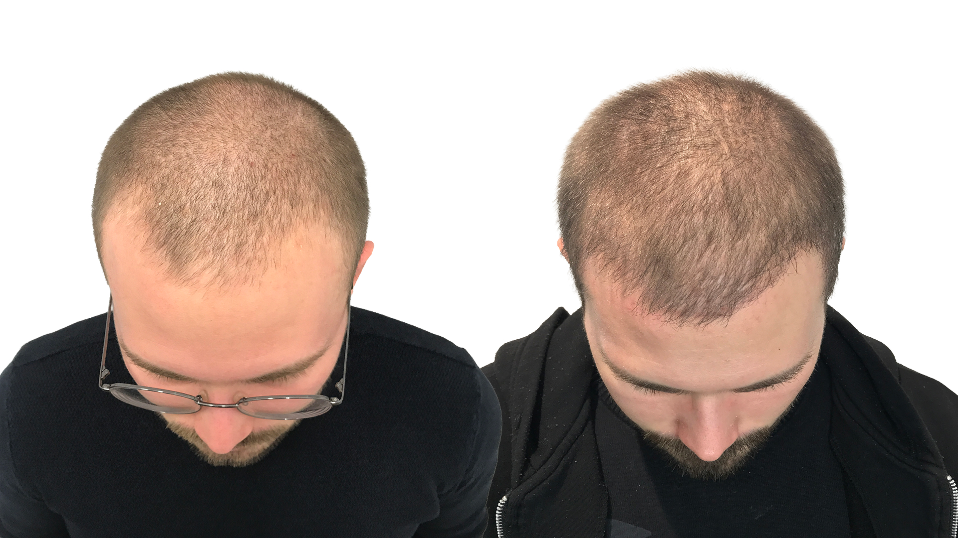 Elias – före och efter sin hårtransplantation