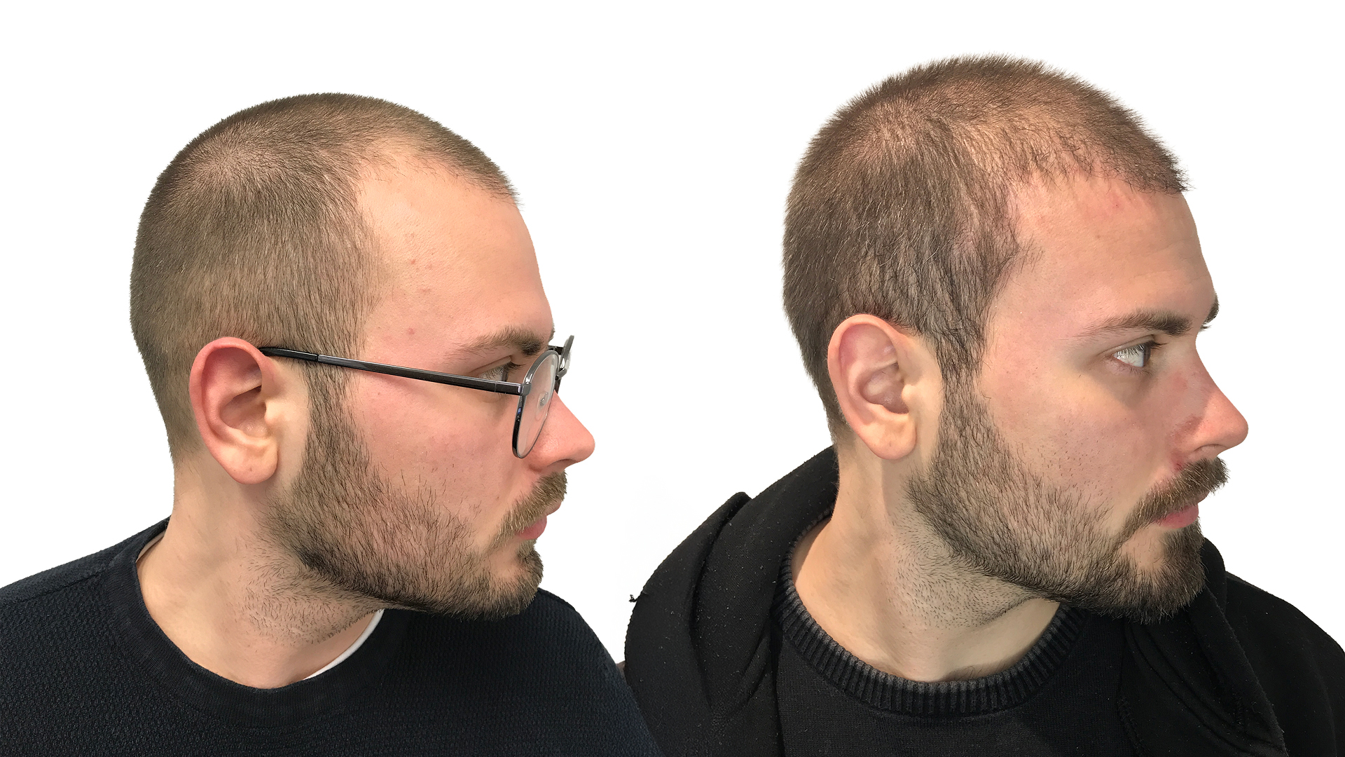 Elias – före och efter sin hårtransplantation