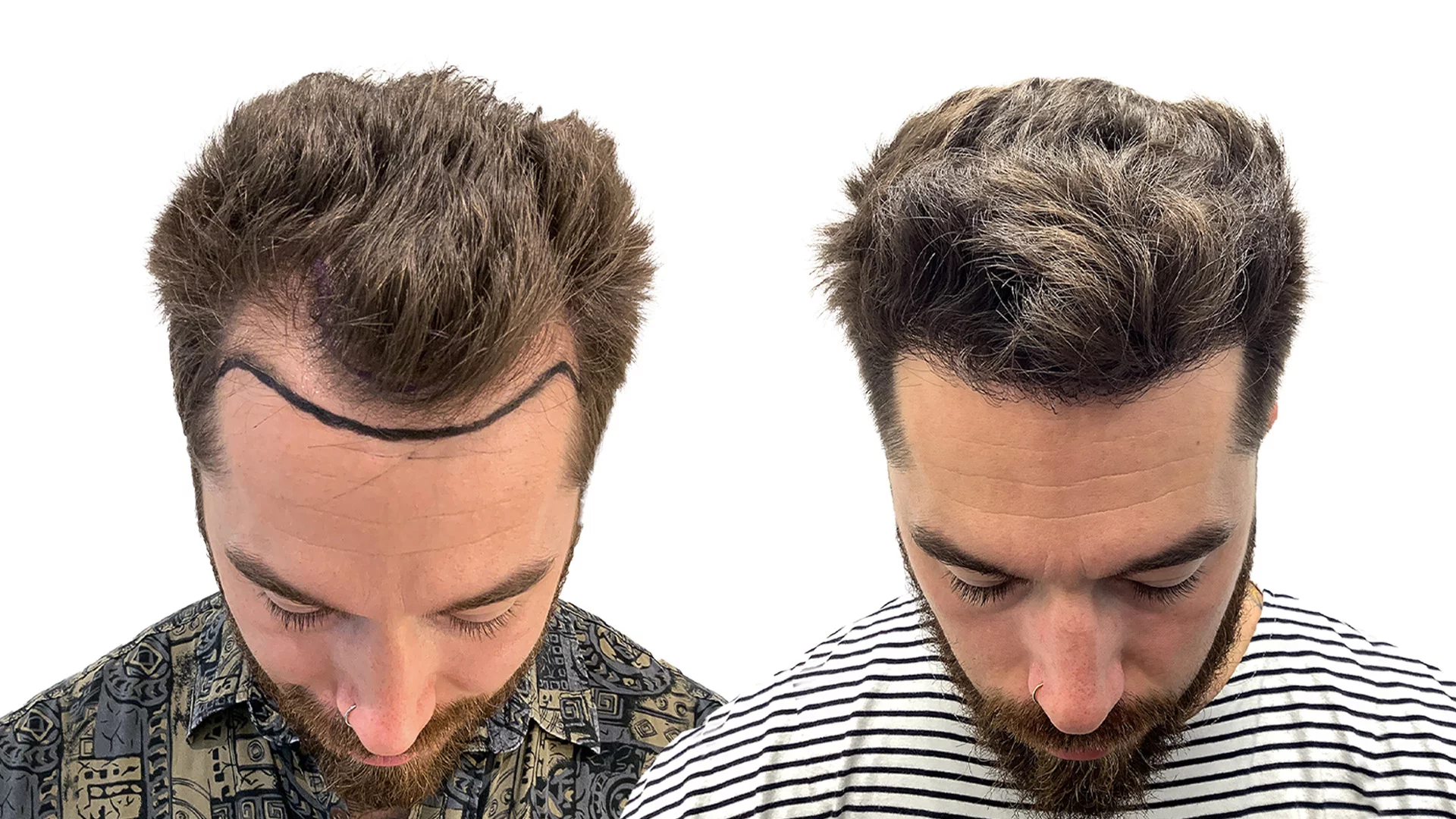 David – före och efter sin hårtransplantation