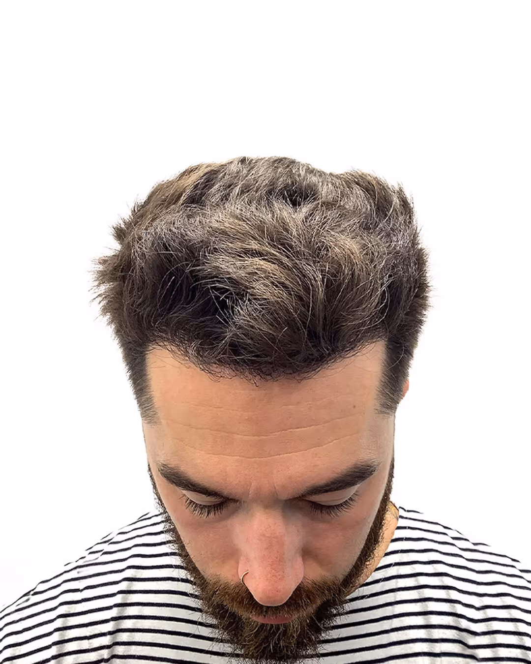 David efter hårtransplantationen