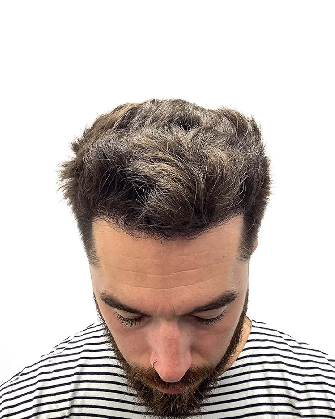 David efter hårtransplantationen