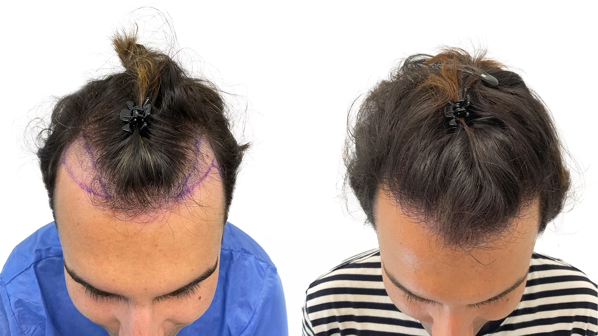 Daniel – före och efter sin hårtransplantation