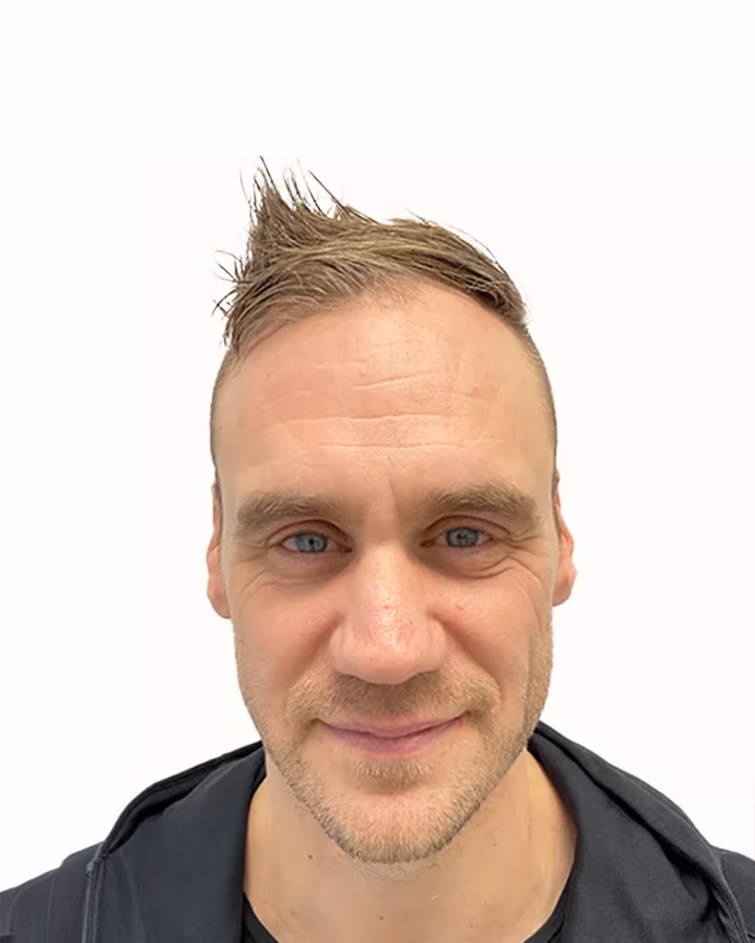 Christer före hårtransplantationen