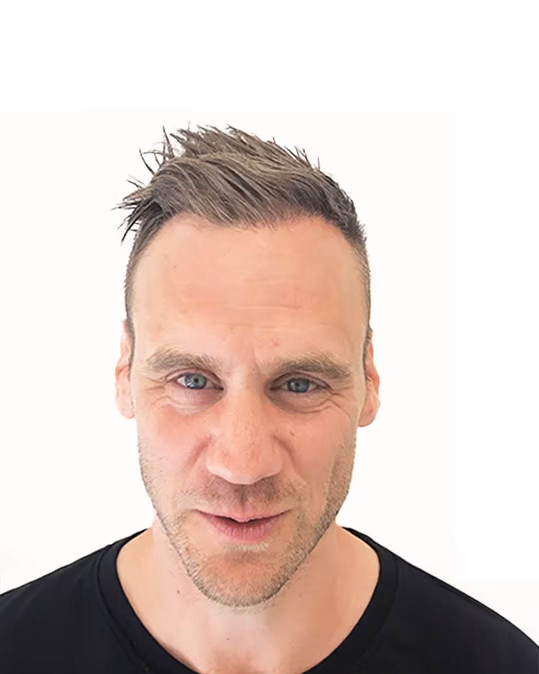 Christer efter hårtransplantationen