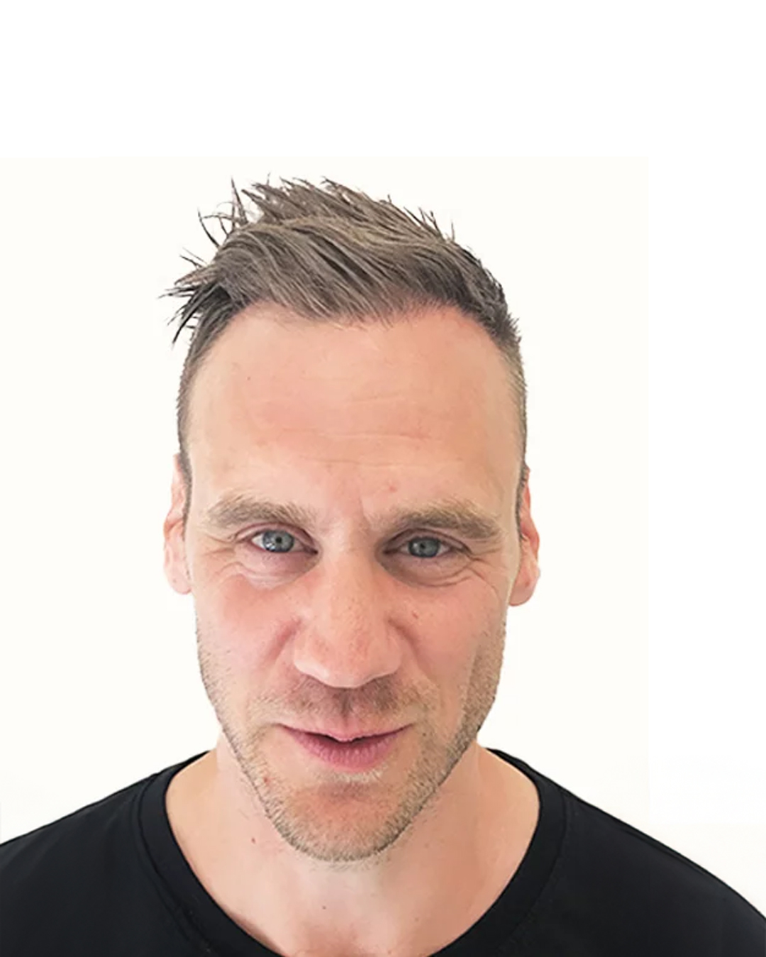 Christer efter hårtransplantationen