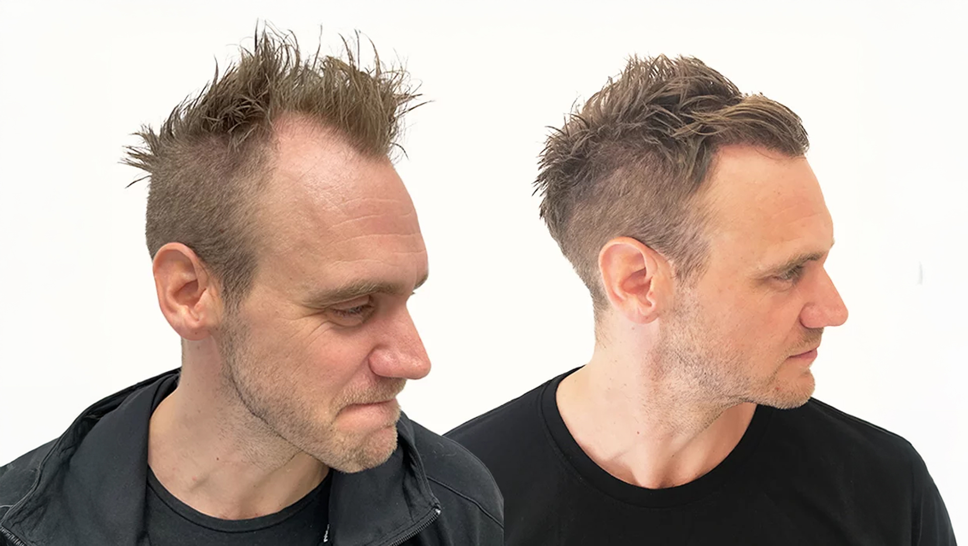 Christer – före och efter sin hårtransplantation