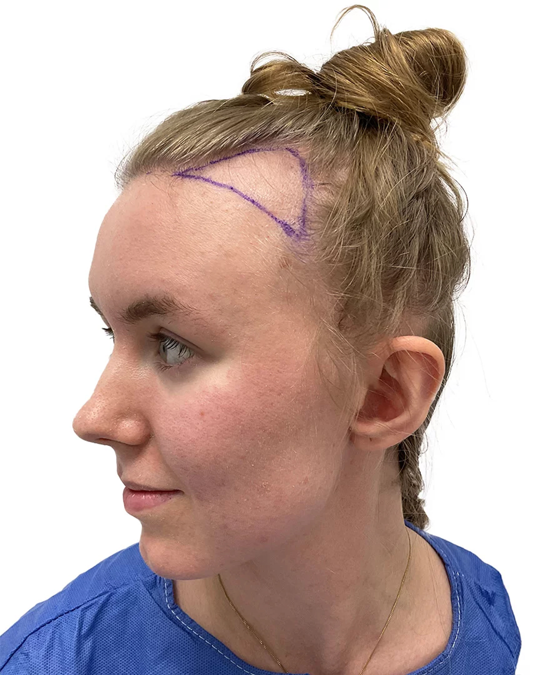 Caroline före hårtransplantationen