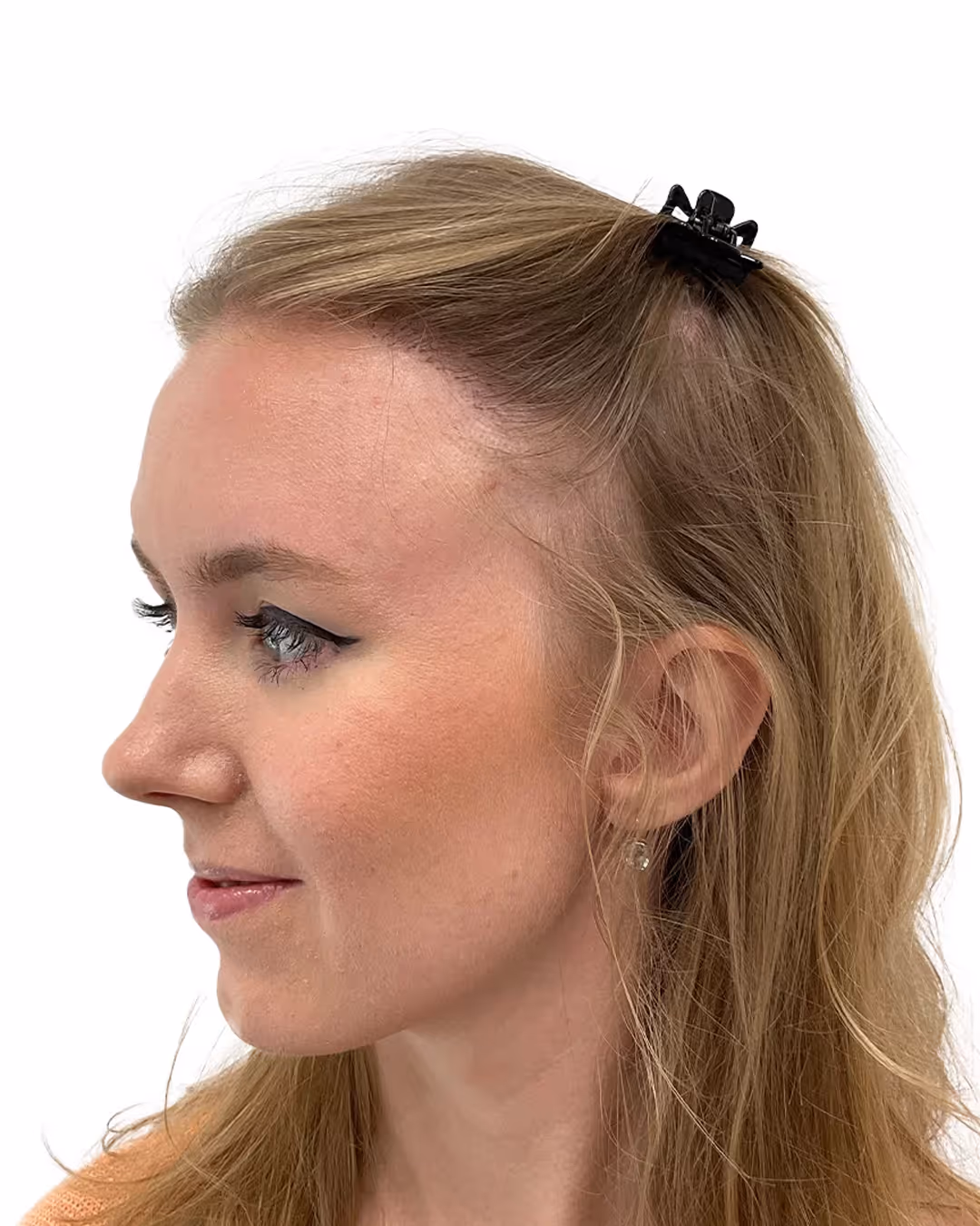 Caroline efter hårtransplantationen
