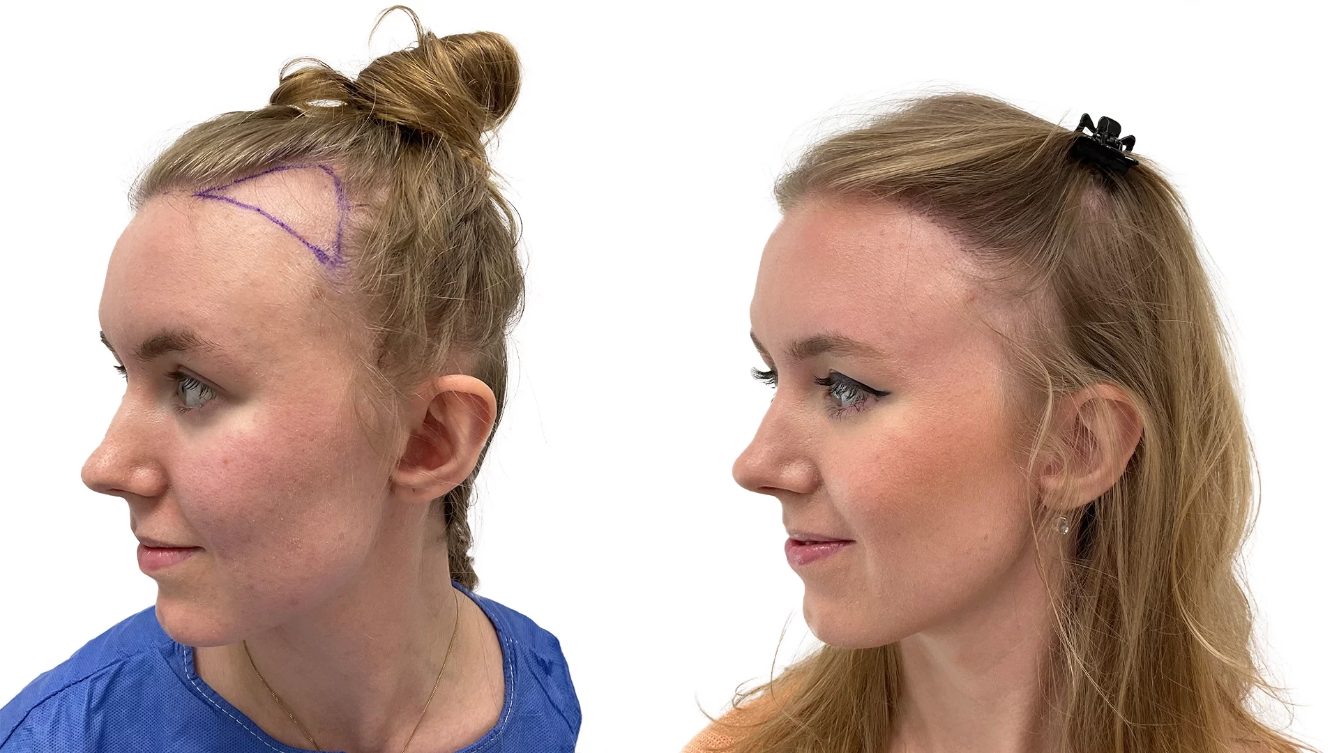 Caroline – före och efter sin hårtransplantation