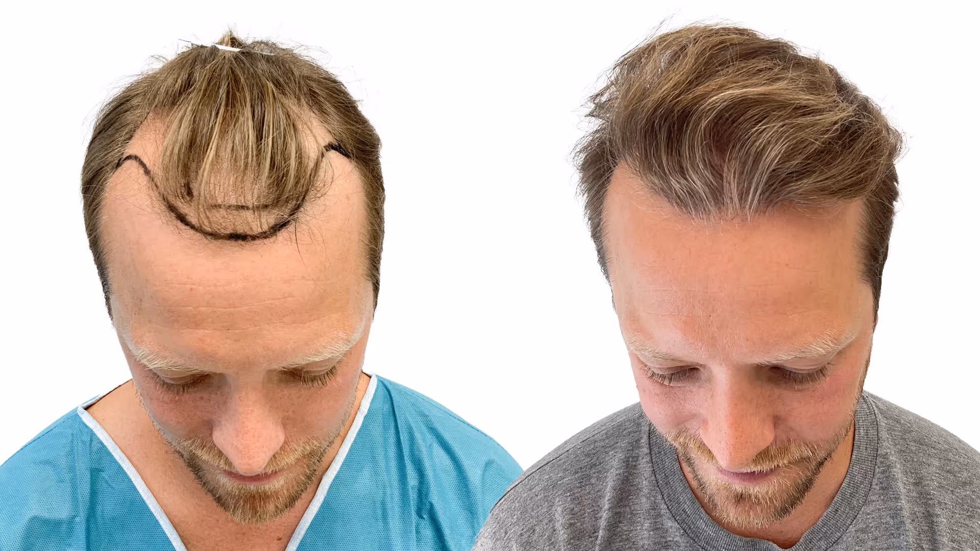 Carl-Johan – före och efter sin hårtransplantation