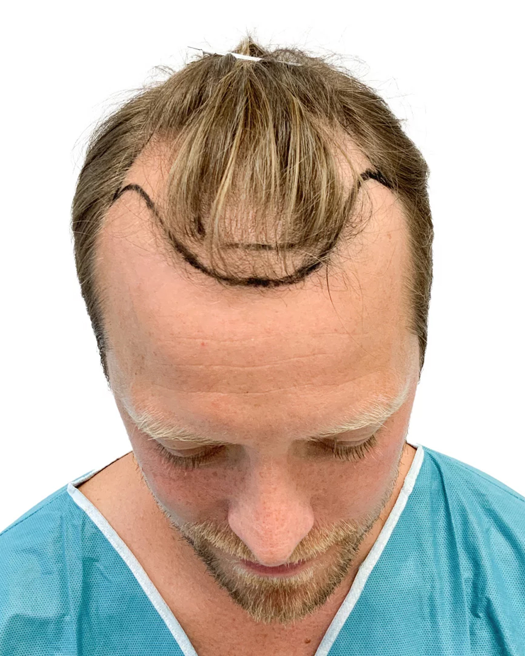 Carl-Johan före hårtransplantationen