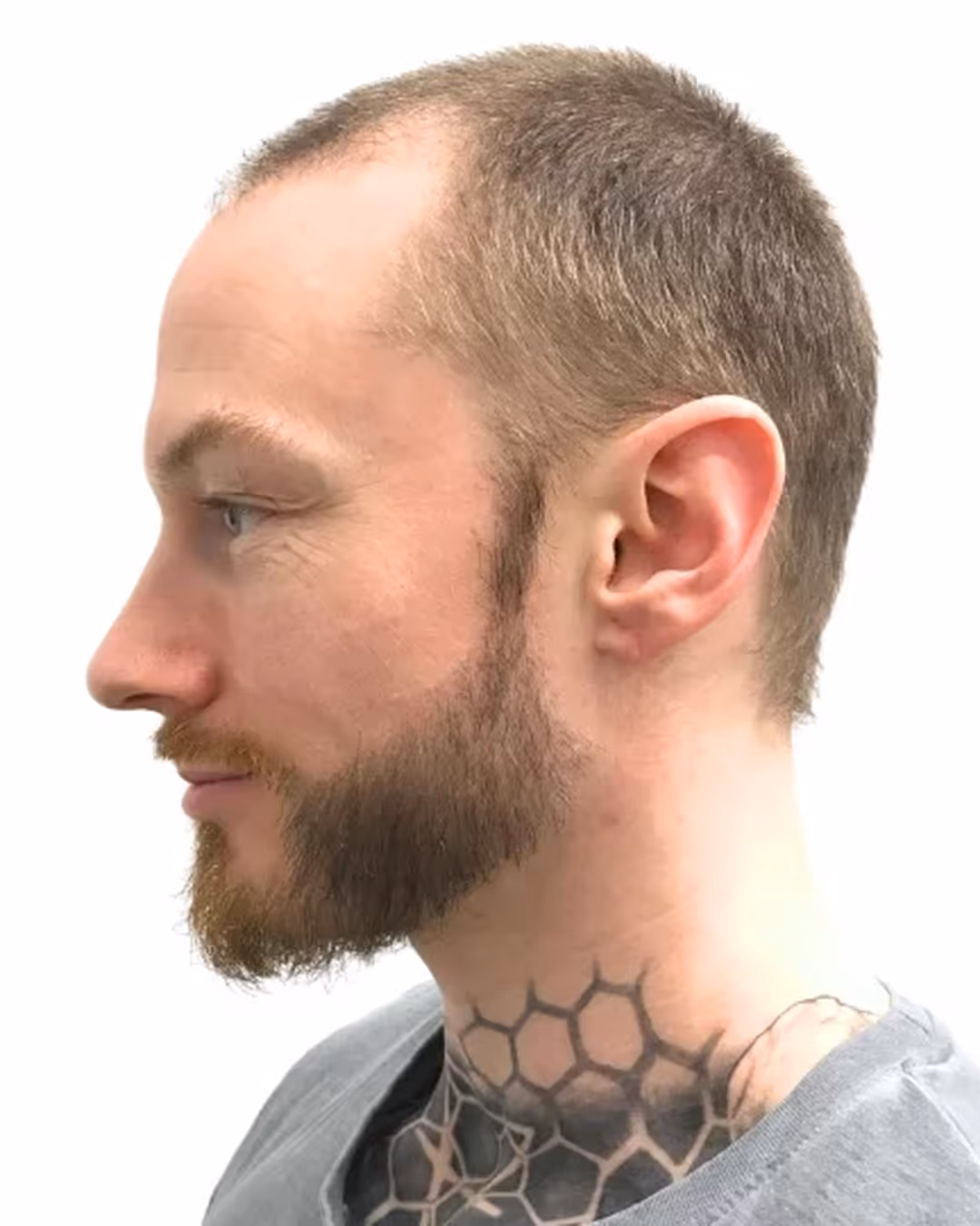 Carl efter skäggtransplantationen