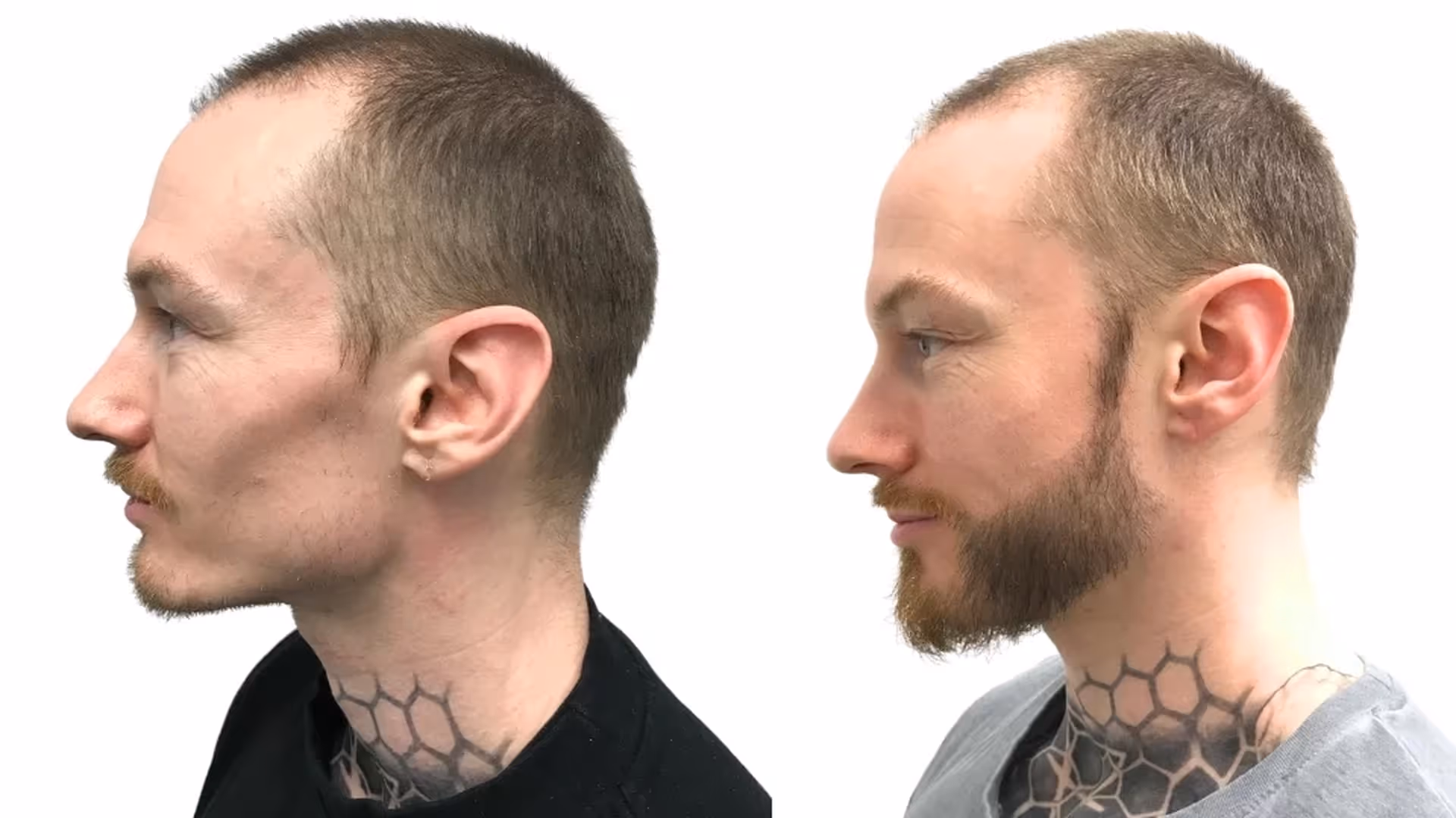 Carl – före och efter sin skäggtransplantation