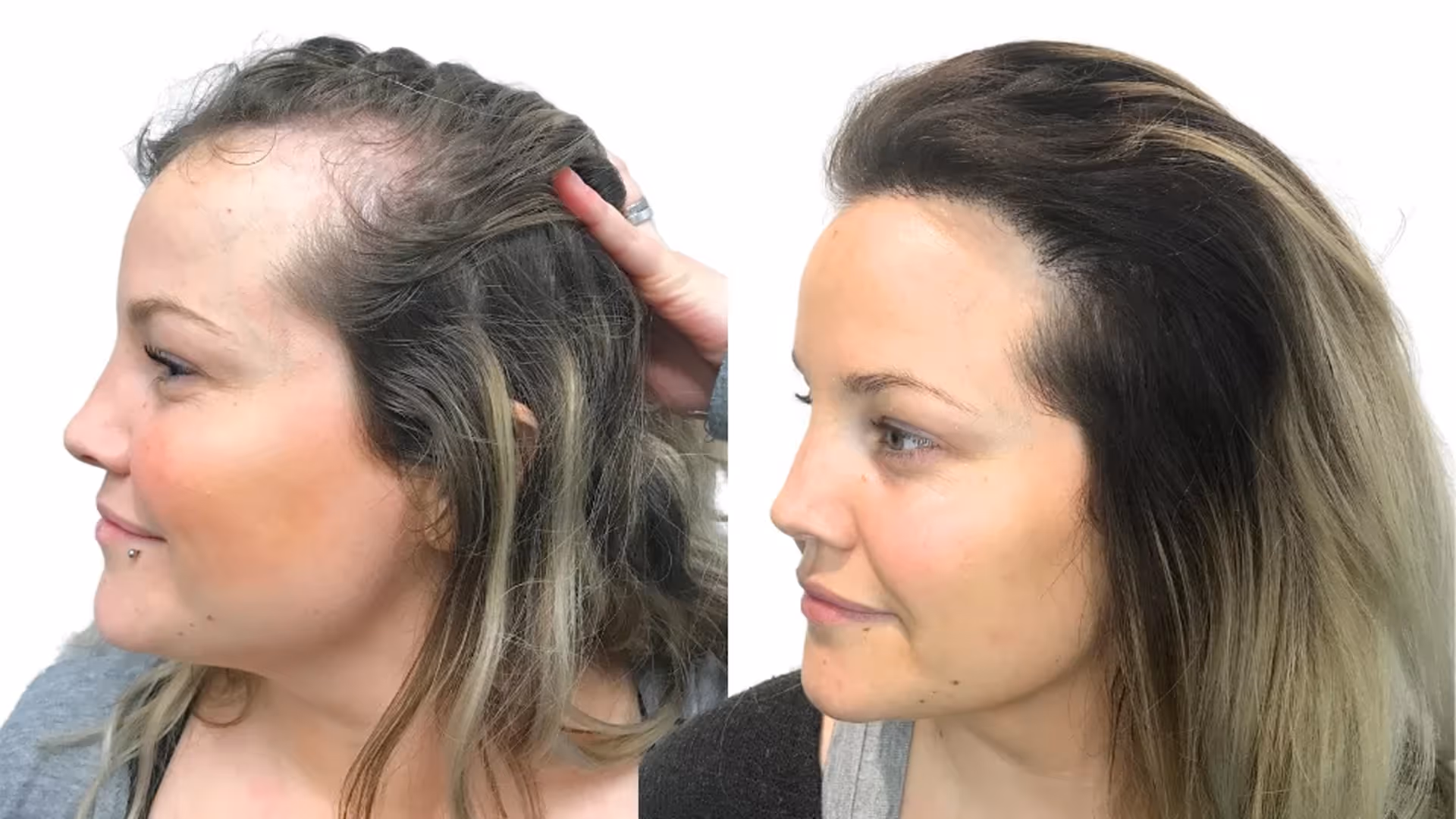 Camilla – före och efter sin hårtransplantation