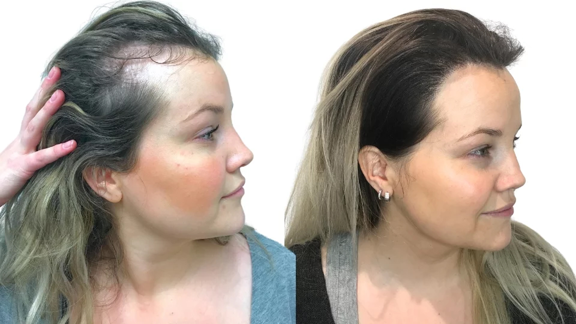 Camilla – före och efter sin hårtransplantation