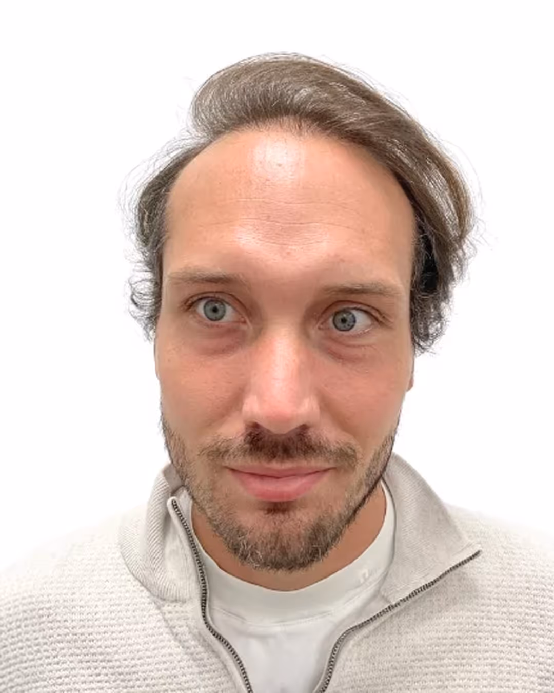 Buster efter hårtransplantationen