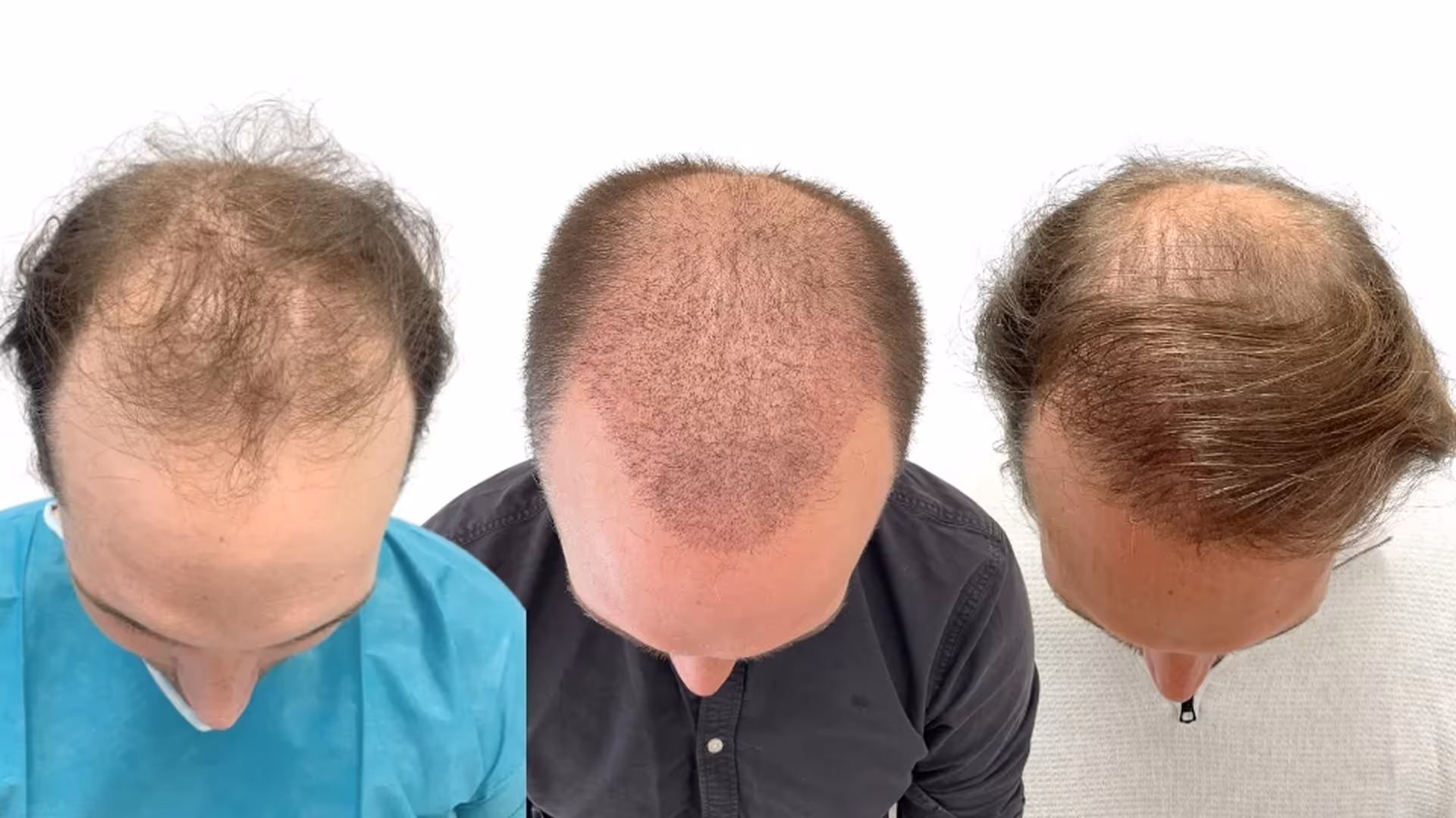 Buster – före och efter sin hårtransplantation