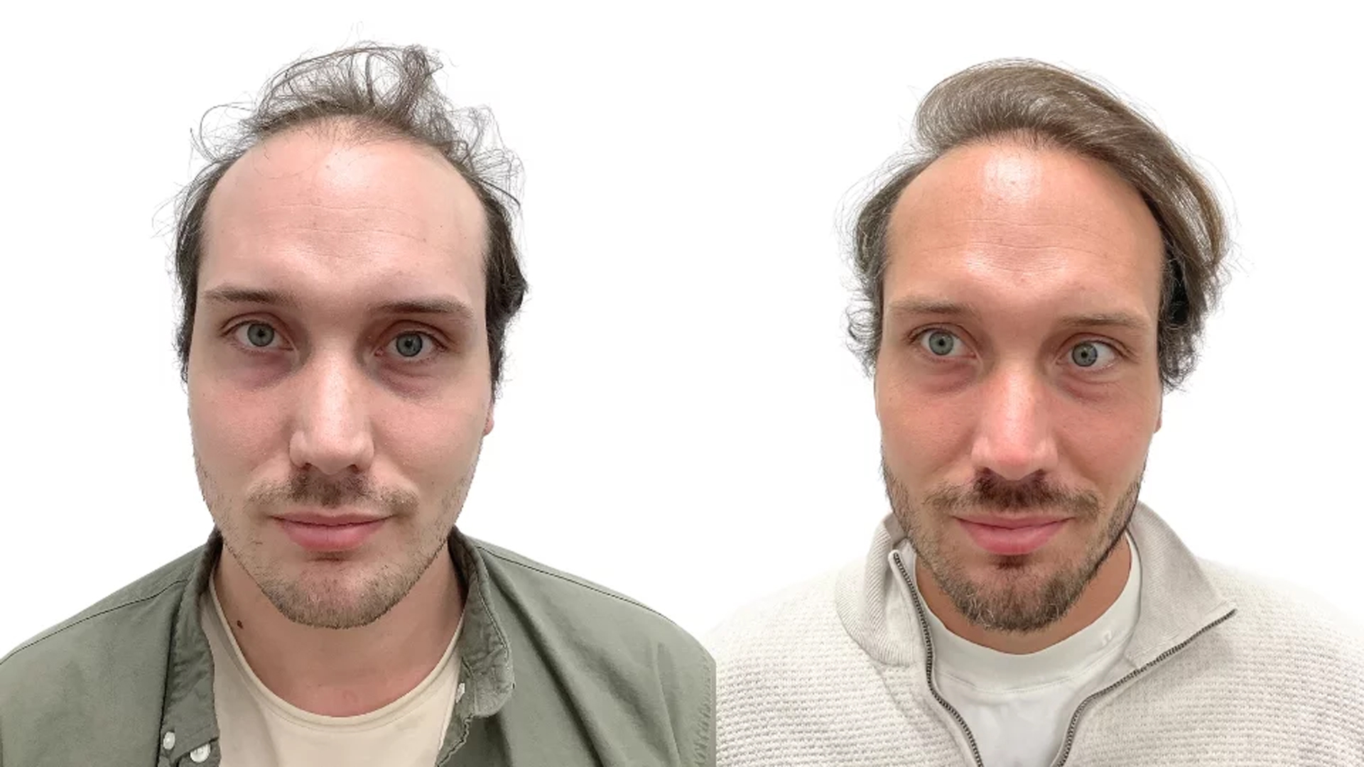 Buster – före och efter sin hårtransplantation